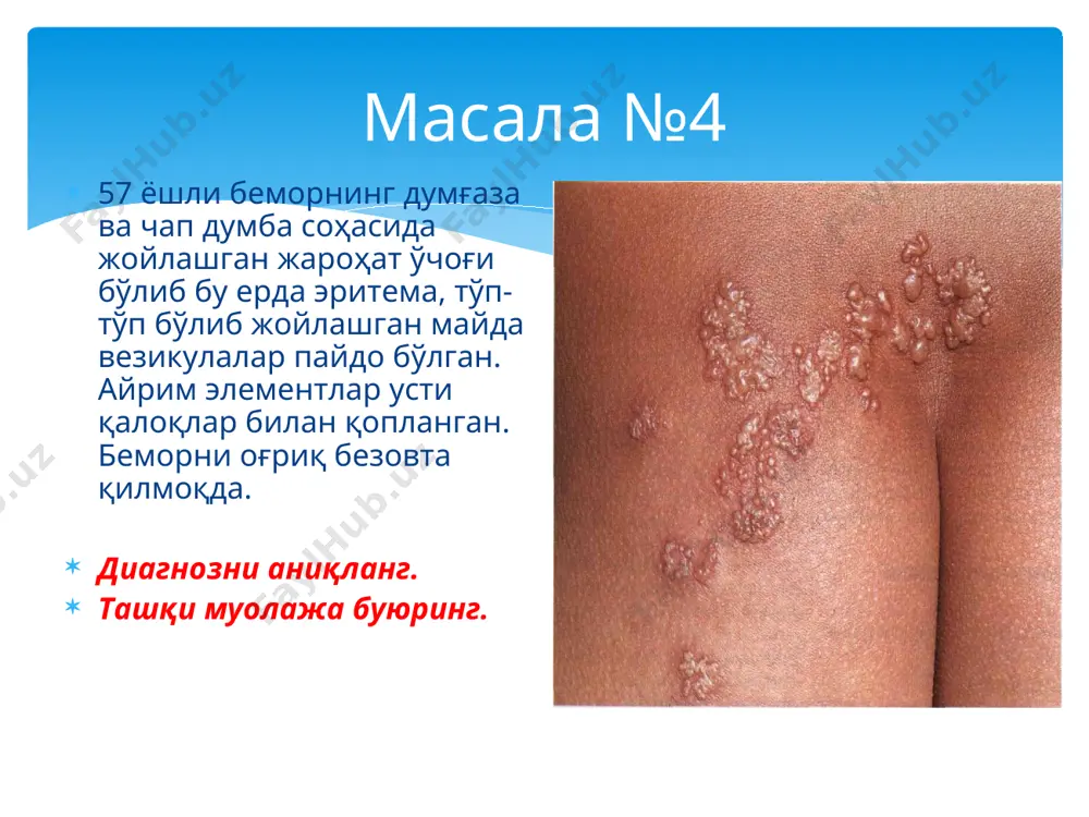 ilishi, tirnoqning distrofik o'zgarishi paronixiya va onixiya kuzatilmoqda. umumiy ahvoli og'ir. sizning tashxisingiz? asosiy davo choralari. masala №18 dermatolog huzuridagi 2 yoshli qizchaning yuzlari, pastki jagi terisida ko'pgina fliktena elementlari, eroziyalar mavjud bo'lib, eroziyalar usti qaloqlar bilan qoplangan. elementlar atrofida giperemiya xoshiyasi kuzatiladi. jarayon sohasi asta-sekin kattalashib bormoqda. 1) qaysi kasallik haqida o'ylash kerak? 2) tashqi davolash uchun nima buyuriladi? masala №19 bemor a. xirurg huzuriga orqa peshov atrofida toshma toshishiga shikoyat qilib murojaat qildi. ko'rilganda: orqa peshov atrofida yuzasi eroziyalangan, namlanuvchi papulalar bor. bemorda kattaligi 1 so'mlik tangadek keladigan oz miqdordagi oqish-pushti rangdagi rozeolalar bor. bemorda qanday kasallik bo'lishi mumkin? bemorni qaysi mutaxassis ko'rishi kerak? qanday laboratoriya analizlari qilish kerak? masala №20 teri bo'limiga 12 yoshli qizcha og'ir ahvolda yotqizildi. shikoyati: katta bo'g'imlardagi og'riqqa, isitma chiqishiga, teriga toshmalar toshishiga. ko'rilganda: bemorning ahvoli og'ir, isitmasi 38,8 s. bemorning yuz sohasida diffuz eritema, yuzlari shishgan, ko'zlari qisilgan. qo'l va oyoq panjalari …