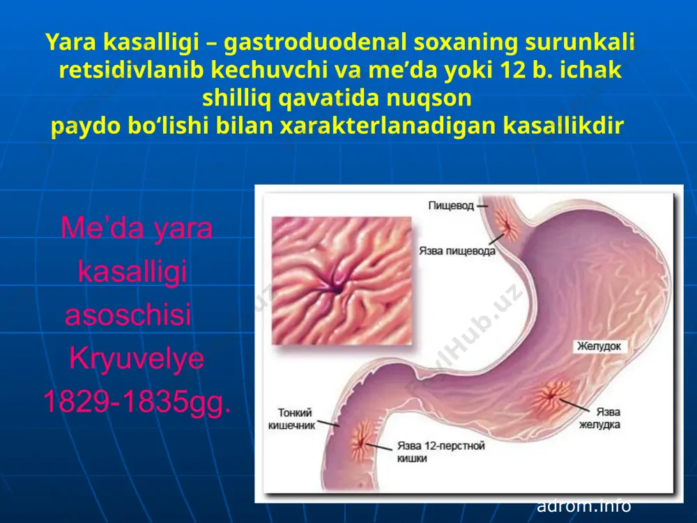 mukofoti bilan taqdirlanishdi klinik kechishi tipik atipik (og‘riq sindromining atipikligi). meʼda sekretsiyasi darajasi. gipersekretor giposekretor kechish xarakteriga ko‘ra. birinchi marta aniqlangan yara kasalligi retsidivik kechuvchi gox-gox qo‘zib turuvchi (2-3 yilda 1marta qo‘zuvchi) xar yili qo‘zuvchi tez-tez qo‘zuvchi (yiliga 2-marta yoki undan ko‘p) kasallik stadiyasi bo‘yicha qo‘zish remissiya: klinik anatomik: epitelizatsiya, chandiqlanish ( qizil chandiq stadiyasi 4-6 xafta, oq chandiq 3-6 oy). funksional asoratlar 1. qon ketish 3. perforatsiya 2. penetratsiya 4. stenozlanish 5. malignizatsiya. diagnostika klinik mezonlari, yosh, jins va yarani lokalizatsiyasi bo‘yicha o‘ziga xos klinikasi. qon guruxini aniqlash axlat analizi. qorin bo‘shlig‘i organlarini uzt. meʼda shirasi tekshiruvi. egds pritsel biopsiya bilan. meʼda va 12 b. ichak r-skopiyasi 8. h. pylori ni anqlash. yara tiplari. yagona bir-qancha yara o‘lchami. kichik, diametr 0,5 sm gacha. o‘rta, diametr 0,5-1 sm gacha. katta, diametr 1,1-2,9 sm. gigant, diametr 3 sm va undan kattasi meʼda yarasida, 2 sm dan katta 12 b. ichak yarasi …
