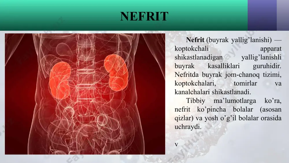 lig’lanishi. glomerulonefrit — glomerulaning yallig’lanishi bilan ifodalangan buyrak kasalligi. shuntli nefrit — buyrak koptokchalarining immunitet kompleksining asorati bilan ifodalanadigan kasallik turi hisoblanadi. davolash kerakli davolash buyrakdagi yallig’lanish jarayonining shakliga qarab tanlanadi. o’tkir nefritda maxsus parhez, suyuqlikning cheklangan iste’moli va yotoq tartibiga amal qilish buyuriladi. terapiyaning asosi antibiotiklar bilan davolashdir. ko’pincha kefzon, gentamisin, penitsillin, seporin asosidagi antibakterial preparatlar qo’llaniladi. antibiotik terapiyasining jiddiyligi bemorning holatiga bog’liq. agar nefritda konservativ davolash kerakli natijalarni bermasa, bu holda bu yiringli shishlarni ochish va buyraklar dekapsulatsiyasi qilish uchun jarrohlik operatsiyasini o’tkazish masalasi ko’rib chiqiladi. davolanishning muvaffaqiyatli yakun topishi asosan bemorning intizomi va barcha tibbiy tavsiyalarga amal qilishiga bog’liq. asoratlari kerakli davolanishsiz nefrit surunkali bosqichga o’tishi mumkin, bu esa buyrak yetishmovchiligi rivojlanishi xavfini tug’diradi. shunindek yurak-qon tomir va nafas olish tizimlari asoratlari rivojlanishi ham mumkin. oldini olish nefritning oldini olish barcha yuqumli kasalliklarni o’z vaqtida davolashga borib taqaladi. chiniqish, sog’lom turmush tarzi, muvozanatli parhez va immunitet darajasini …