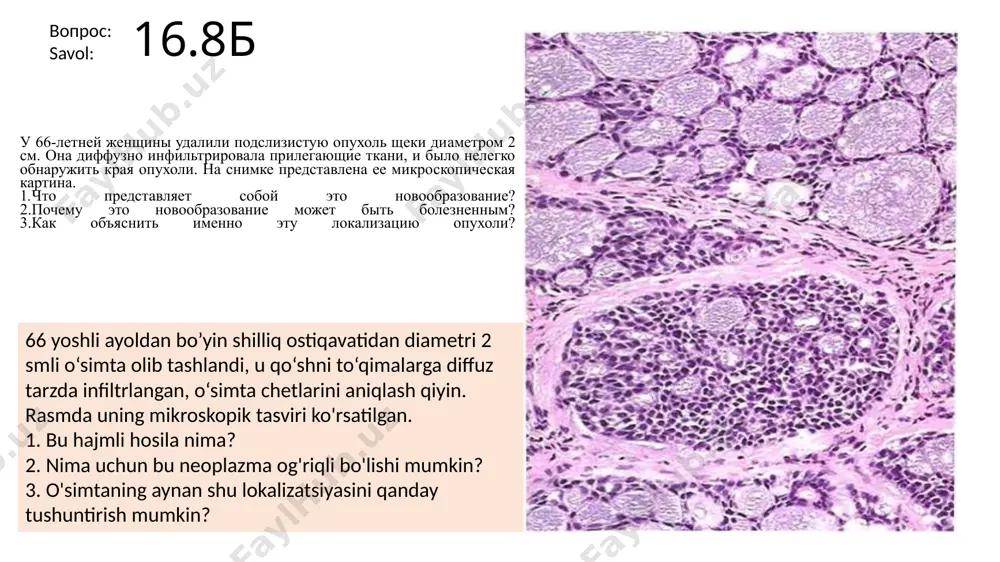 yalanish xavfi so’lak bezining hajmiga teskari proportsionaldir. javoblar u 49-letney jenshini s tranzitornoy arterialnoy giper­tenziey v anamneze na pravoy storone shei viyavlena opu­xol 3 sm v diametre. novoobrazovanie imeet infiltri­ruyushie kraya, v svyazi s chem ee trudno udalit. na snimke predstavleni mikroskopicheskaya kartina i angiogramma. nazovite veroyatniy diagnoz. 1. kakovo vashe zaklyuchenie o forme patologii u patsientki? 2. v kakix regionax eshe mogut vozniknut takie opuxoli? 3. pochemu u patsientki razvilas arterialnaya gipertenziya? anamnezida tronzitor arterial gipertenziya bilan og‘rigan 49 yoshli ayolda bo‘ynining o‘ng tomonida 3 sm o‘simta borligi aniqlandi. hajmli hosilaning infiltratsion qirralari bor, shuning uchun uni olib tashlash qiyin. rasmda mikroskopik rasm va angiogramma ko'rsatilgan. ehtimoliy tashxisni ayting. 1. bemordagi patologiya shakli haqida qanday xulosaga keldingiz? 2. bunday o'smalar hali ham qaysi hududlarda paydo bo'lishi mumkin? 3. nima uchun bemorda arterial gipertenziya rivojlandi? 16.9 strona b na uchastke karotidnoy bifurkatsii etoy paragangliomi otmechaetsya «pokrasnenie» (■) vsledstvie usileniya ee …