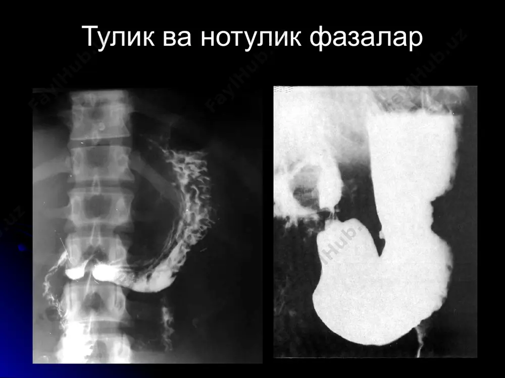 бевосита белгилар токча < 2 cм (барий доги, депоси) яллигланиш инфильтрати билвосита белгилар перистальтика ошиши локал спазм («курсаткич бармок» симптоми), гиперсекреция атроф рельеф узгариши (шиши еки бурмалар конвергенцияси) локал огрик яра сохасида асоратлар - 1) перфорация, 2) пенетрация 3) чандикли деформация 4)кон кетиш 5)малигнизация 12-бармокли ичак яраси ошкозон ярасига нисбатан х2-3 баравар купрок учрайди купрок эркакларда 95% пиезчада, < 1 см кичик 85% пиезча деформациялашади малигнизация йук белгилари ва асоратлари ошкозон ярасидек образец текста второй уровень третий уровень четвертый уровень пятый уровень крон касаллиги 80% оч ва енбош ичакда уткир боскич - шиллик кават шиши, рельеф йуколиши - «булыжная мостовая» симптоми, яралар, стеноз, ригидлик сурункали боскич - чандикли торайиш («шнур» симптоми) асорати - фистула, абсцесс, стеноз, перфорация, гидронефроз, токсик мегаколон, аденокарцинома эхтимоли ошиши ичак тутилиши турлари 1) ингичка (80%) ва йугон (20%) ичакли 2) механик ва динамик асосий белги - клойбер косалари механик ичак тутилиши (ичакда тусиклик) 1) перистальтика сакланган …