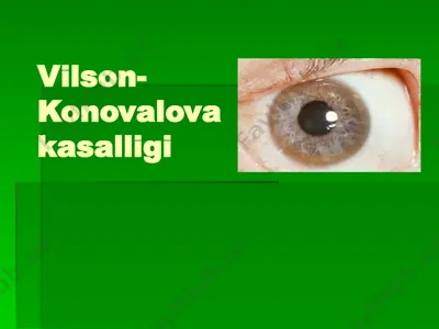 vilson-konovalova kasalligi — PPTX