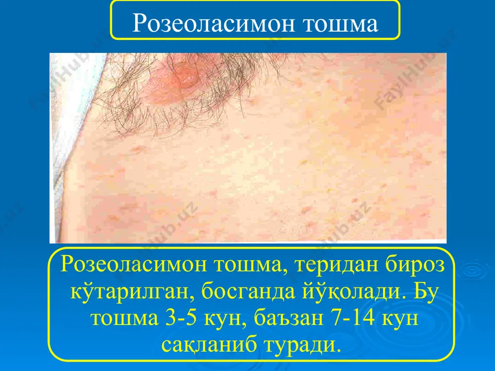 , қўзғалувчанлик, рангпарлик; кўкракни эммаслик, бақириш, йиғлаш; безовталик, адинамия, уйқу инверсияси (кундузи уйқучанлик, кечқурун уйқусизлик); оғир кечувида – қайт қилиш, тиришишлар, эс-ҳушини бузилиши, лаб, оғиз шилиқ қаватлари қуруқ, суюқ нажас, токсикоз-эксикоз белгилари; эрта ёшдаги болаларда кечиши (1-3 ёшгача) юқтда тахикардия, ақб пасайиши, юрак тонлари бўғиқлашиши; гемограмма – лейкоцитоз, нейтропения ядроли силжиш билан, гипоэозинофилия, эчт ошиши; бронхит, пневмония белгилари (иккиламчи); ичакдан қон кетиши, ичак перфорацияси кузатилади. тиф-паратиф касалликларининг асоратлари жарроҳлик: ичакдан қон кетиши ичак перфорацияси хусусий: пневмония менингоэнцефалит холецистит холангит токсик: инфекцион-токсик шок токсик миокардит токсик нефрит токсик менингоэнцефалит постинфекцион психоз нохусусий: (иккиламчи): пневмония отит пиелонефрит стоматит цистит ташҳисоти: тўлиқ йиғилган клиник-эпидемиологик маълумотлар ва объектив кўрув. юқори иситмаси бўлган беморлар (3 кун ва ундан ортиқ), бошқа патологик белгилар бўлмаса, тиф-паратиф касалликларига текширилиши шарт. лаборатор текшириш усуллари: i. умумий текшириш усуллари: қон, сийдик ва нажаснинг умумий таҳлили. ii. хусусий текшириш усуллари: бактериологик текширув (қон, пешоб, нажас, сафро, баъзан суяк кўмиги, ликвор, розеола, …
