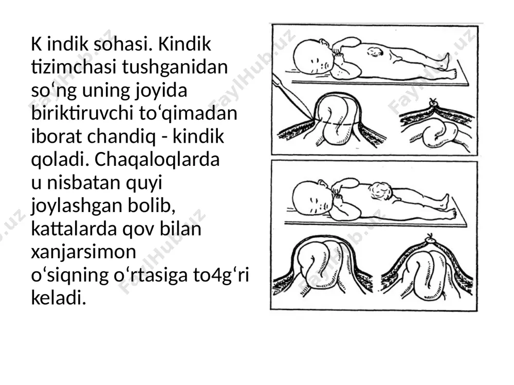 talikni egallashi mumkin (10x8 sm va undan ortiq). bu nuqsonga qorin to'g'ri mushagining hamda ko‘ndalang va qiyshiq mushaklarning aponevrozi aplaziyasi, xanjarsimon o‘siqning chala rivojlanishi, diafragmaning turli nuqsonlari qo‘shilib ketishi mumkin. tugllgan zahoti churra haltasi shaffof boiib, bir kecha-kunduz ichida xiralashadi. unga hamma vaqt infeksiya tushib, yiringli asorat xavf solib turadi. ba’zan tug'uruq paytlari churra haltasi yirtilib, ichki a’zolar chiqib ketishi ham mumkin. 0 ‘lcham lari turlicha b o lib , ba’zan 15x16 sm li katta churralar ham uchrab turadi. sharsim on va konussimon shakllari tafovutlanadi. c hurra haltasining ichida ko'proq ingichka ichakning qovuzloqlari uchraydi, am m o jigar, taloq, m e’da bomishi ham ehtim oldan holi emas. c hurra darvozasi bilan qopdagi a’zolarning olcham lari o'zaro mos kelm aganligi uchun ularni ko‘pincha ichkariga to‘g‘rilashning iloji bolm aydi. kindik tizimchasining churrasi aksariyat qovuq va sariqlik yo‘lining oqmalari, yurakning tug‘ma nuqsonlari, oqma miya churralari bilan uyg‘unlashib uchraydi va prognozni juda yomonlashtiradi. k …