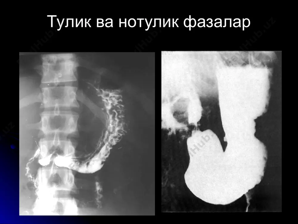 ошкозон-ичак касаллиklarining nur tashhisi - Page 5
