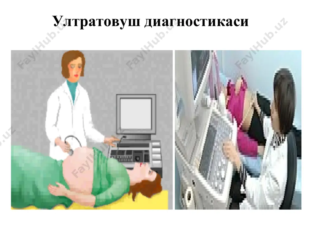 урография - мр-спектроскопия (метаболик ўзгаришли) - суяклардан артефактлар йўқ. магнит-резонанс томография камчилиги: - қимматбахо - тешкирувнинг узоқлилиги (30 мин) - металл ва харакатланиш натижасидаги артефактлар - кесим 3 мм гача - майда суяк парчалари, ўпка, металл, кальцинатлар ёмон куринади - болаларни ва оғир беморларни кўриш ноқулай (анестезия керак). th12 танаси орка ярими ва th10 танаси гемангиомаси ўнг пешона-конвекситал соха менингеомаси фильм мрт асосий терминлар (атамалар) гиперинтенсив – зичлиги юқори бўлган тўқималар (ёг тўқимаси), оқ ранг; гипоинтенсив – зичлиги паст бўлган тўқималар (хаво), қора ранг. замонавий нур усулларини қўллаш узи - корин бушлиги, кичик чанок, куз косаси, юрак, юмшок тукималар, патологияларида, хомила текширишда кулланилади. мрт - мнс ва орқа мия усма ва яллигланиш касалликлари, бугим, кичик чанок, корин бушлиги, юмшоқ туқималар патологияларида қўлланилади. эътиборингиз учун рахмат!
