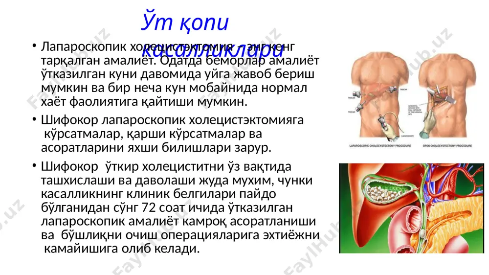 змолитиклар) мухимдир. агар дивертикулитни асоратлари, симптомлари ёки рентгенологик белгилари кузатилса жаррох маслахати шарт. ингичка ичак тутилиши қорин бўшлиғида операция ўтказилиши оқибатида чандиқлар сабабли тахминан 60% холларда ингичка ичак тутилишига олиб келади. ўткир ичак тутилиши- шошилинч хирургиянинг энг кўп сабабидир. чурраларнинг қисилиши ва хавфли ўсмалар доимгидек кўпроқ ўлимга олиб келади. улар барча хирургик госпитализацичнинг 12% дан 16% гача қисмини ташкил этади. ичак тутилишини кардинал анъанавий симптомлари бу - қоринда санчиқли оғриқ, қайт қилиш, қорин дам бўлиши ва абсолют қабзият. аммо кўпчилик беморларда касалликнинг барча белгилари намоён бўлмайди, баъзиларда хатто газ ажралиши ва ич келиши хам сақланиши мумкин. ичак тутилишига шубха бўлганда беморлар шошилинч ёрдам бўлимига келиши билан рентген текширувидан ўтишлари лозим. ичак кенгайиши ва хаво устида суюқлик сатхининг бўлиши яъни «клойбер косачалари» диагнозни тасдиқлайди. рентгенда ичак тутилиши белгилари бўлмаса, лекин клиник белгилари мавжуд бўлса, орал контрастлаш билан кт ўтказилиши лозим. бирламчи терапия – сув ёки электролит алмашинуви бузилишини коррекцияси лозим. агар …