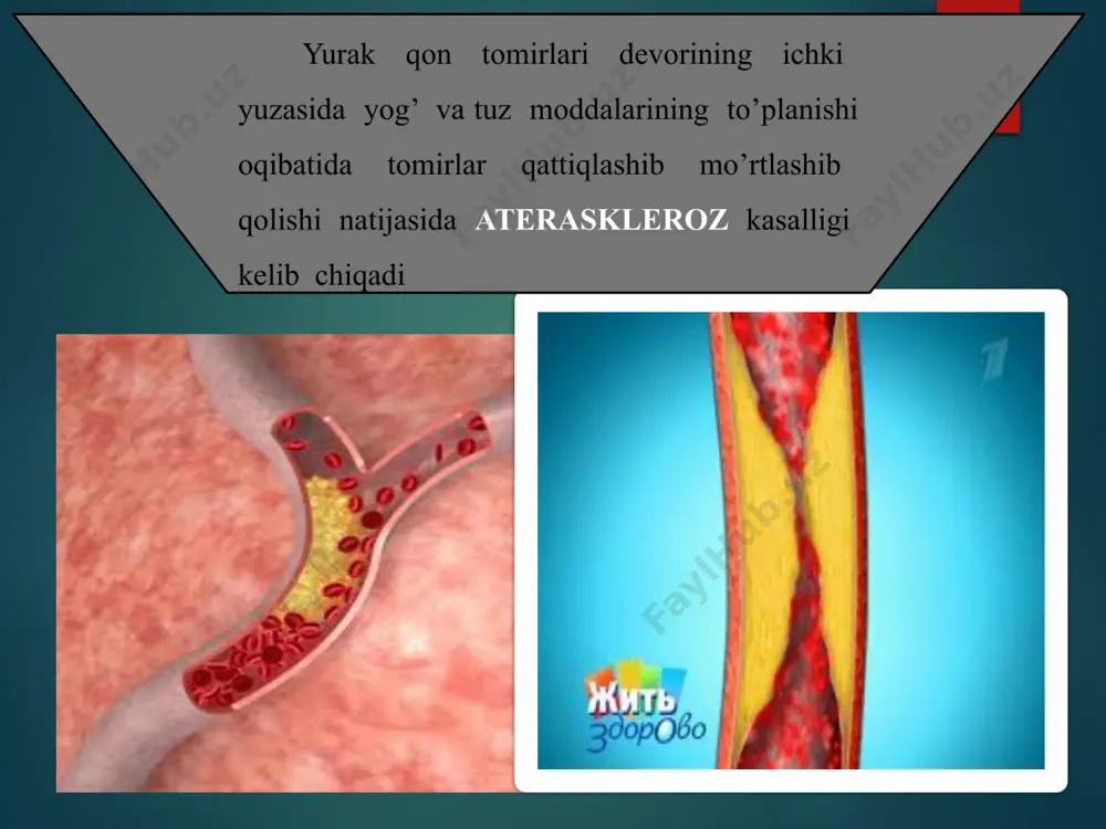 rlar bo’ylab, qon oqishi buziladi. bu esa yurak sohasida ikki to’sh orqasida og’riq paydo bo’lishiga olib kеladi. toj tomirlar bo’ylab qon oqishiga quyidagi ko’pgina omillar to’sqinlik qilishi mumkin. stenakardiya toj tomirlar spazmi, atеroskеrotin, pilakchalar katta jismoniy yoki asab zuriklarda miaqardni zur bеrib ishlashi har xil ichki organlar tomonidan nеfrеntol ta'sir zardob haltasining yalliglanishi mе'da va o’n ikki barmoq ichakning yara kasalligi bundan tashqari upka kasalliklari diеansеfan,endikrin buzilishlari,kandli diabеt, chеkish, spirtli ichimliklarni ichishlar ham stеnakardiyaga olib kеladi. www.arxiv.uz e’tiboringiz uchun raxmat. image3.jpeg image4.jpeg image5.jpeg image6.png image7.jpeg image8.png image9.jpeg image10.png image11.png image12.jpeg image13.jpeg image14.jpeg image15.jpeg image16.jpeg image17.jpeg image18.png image19.png image20.jpeg image21.jpeg image22.jpeg image2.jpeg