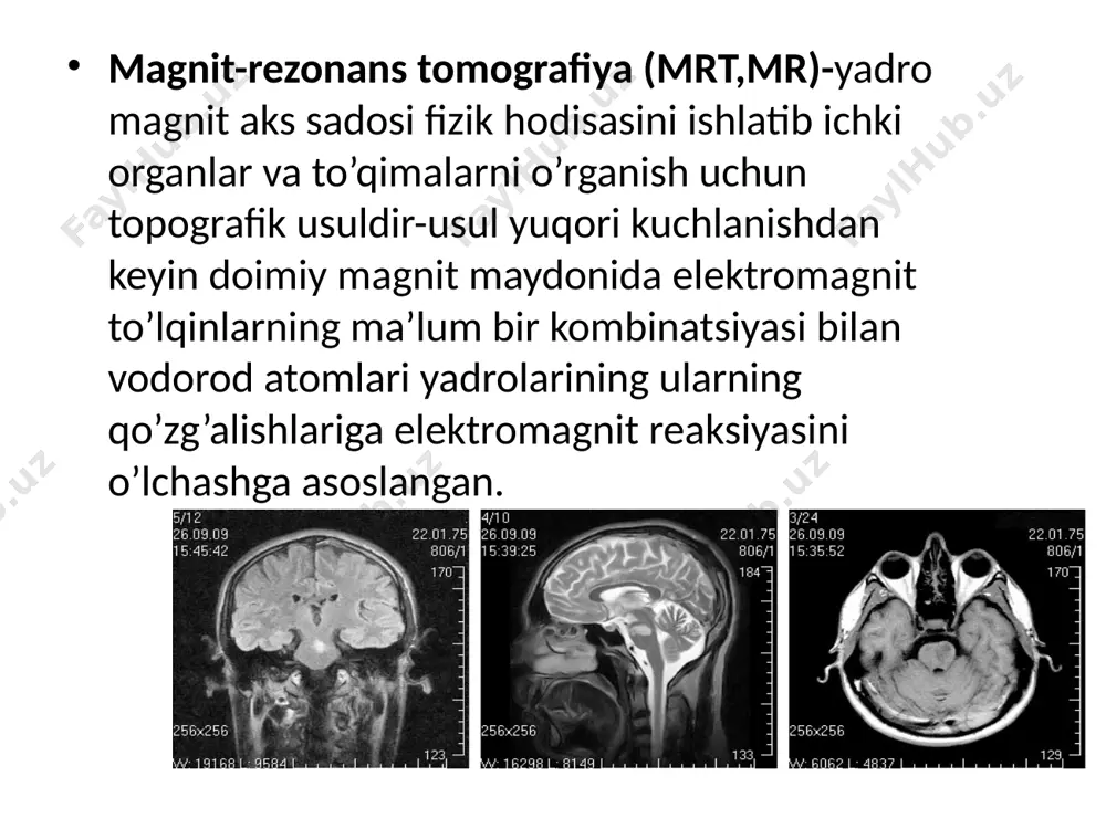 tl, tasvir sifati past bo’lgan. zamonaviy tomografiya kuchli magnit maydon manbalariga ega. shu manbalar orqali 9,4tl gacha elektromagnit maydon hosil qila oladi. doimiysi esa 0,7tlgacha. magnit rezonans tomografiya qurilmasi bosh miya mrt ko’rsatmalari kechiktirib bo’lmaydigan holatlarda bosh miya travmasida bosh miyadagi qon aylanishining o’tkir buzulishida rejali tadqiqotlarda bosh miya yoki uning po’stlog’idagi o’smalarni tekshirishda yuzdagi travmalarda miyadagi anomaliyalarni rivojlanishida gipofiz kasalliklarida ko’krak qafasi va chanoq sohasidagimrt ko’rsatmasi o’sha sohadagi o’smalarda yurak porogida (klapansiz) ko’krak aortasi kasalliklarida perikardda stenokardiyada kardiomiopatiyada bachadon, tuxumdon,qovuq kasalliklarida orqa miya va umurtqa pog’onasi mrt ko’rsatmasi birlamchi suyak o’smalarida metastazda muskullardagi travmalarda suyaklar osteomiyelitik o’zgarishlarida umurtqa pog’onasi disklardagi travmalarda orqa miya va uning pardasi o’smalarida seringomiyeliya kasalliklarida qo’llab bo’lmaydigan holatlar kardiostimulyator ulangan bo’lsa o’rta quloqda feromagnit va elektron implantlar qo’yilganda og’ir metall implantlar bo’lganda miyaga qon aylanishini yaxshilovchi klipslar ulanganda mrt diagnostikasi bosqichlari dastlab bemor to’g’risida ma’lumot yig’iladi. bemor kasallik tarixi o’rganiladi tadqiqotga tayyorgarlik ko’riladi yer magnit …