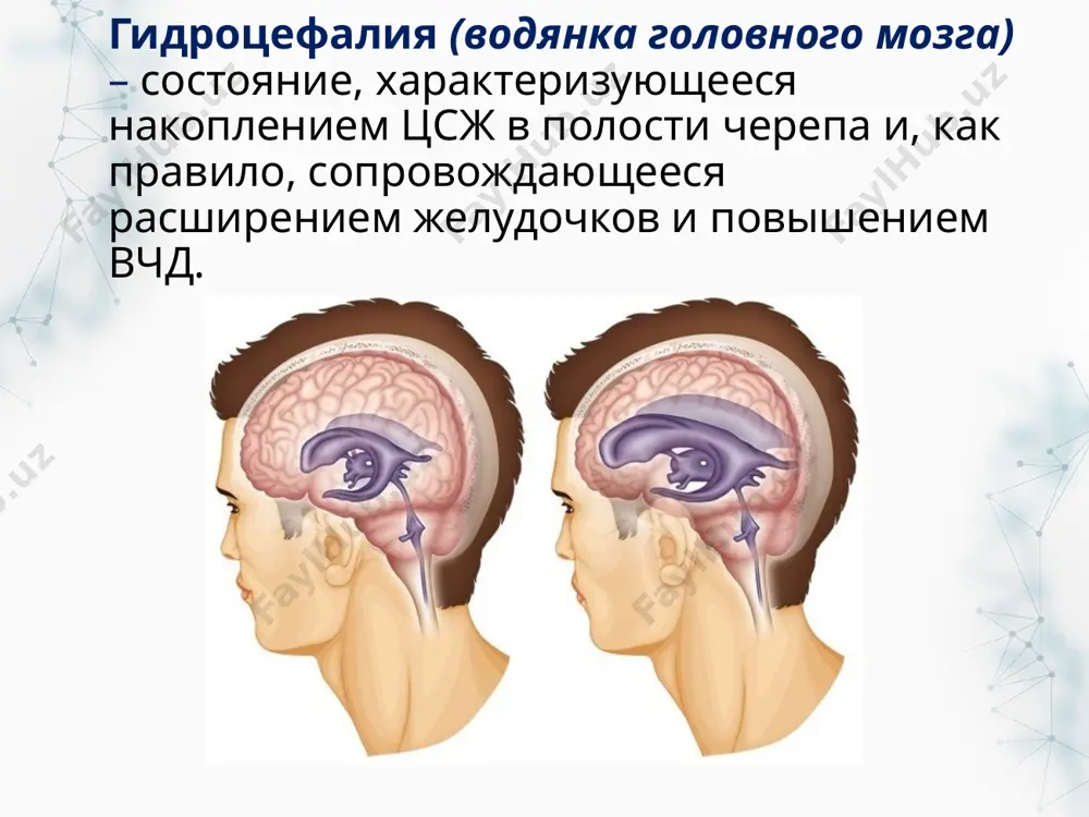 + конвергирующий нистагм + ретракция век + паралич аккомодации + утрата реакции на свет) нормотензивная гидроцефалия вариант сообщающейся (необструктивной) гидроцефалии, связанный с нарушением всасывания цсж на конвекстиальной поверхности головного мозга. расширение желудочков происходит при отсутствии клинических признаков внутричерепной гипертензии, а давление цсж при лп оказывается нормальным или незначительно повышенным причины: фиброз и сращение мозговых оболочек декомпенсация врожденной гидроцефалии в пожилом возрасте клинические проявления (триада хакима-адамса) нарушения ходьбы – «апраксия» ходьбы, лобная дисбазия 1 деменция 2 нарушения мочеиспускания 3 3 nb! нормальная походка у больного с деменцией исключает нормотензивную гидроцефалию; мрт признаки церебральной атрофии (а) при болезни альцгеймера и (в) нормотензивной гидроцефалии на снимке справа отмечается округлая форма рогов боковых желудочков, сглаженность борозд больших полушарий. тест фишера или «tap-test» однократное выведение 20–50 мл ликвора при люмбальном проколе или выведение по 30 мл в течение 3 дней фиксируется: - исходное давление количество забранного ликвора конечное давление регрессия/сохранность клинических проявлений диагностика рентгенография figure …