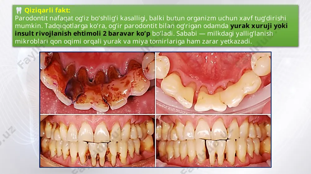 asida tremalar (bo‘shliqlar) paydo bo‘ladi.  natijada travmatik okklyuziyalar yuzaga kelishi mumkin.  rentgenologik belgilar:  tish ildizi uzunligining 1/3 qismidan 1/2 qismigacha bo‘lgan joyida suyak to‘qimasi destruksiyasi aniqlanadi.  alveolalararo to‘siq qirralari balandligi pasayadi. 🦷 parodontitning o‘rta darajasi 🦷 parodontitning og‘ir darajasi klinik belgilar:  parodontal cho‘ntaklar chuqurligi 5 mm dan ortadi.  tishlarning patologik qimirlashi ii–iii darajali bo‘ladi.  tishlar o‘z o‘rnidan siljiydi.  travmatik artikulyatsiya kuzatiladi.  tishlar orasida tremalar va tish qatorida nuqsonlar paydo bo‘ladi.  ko‘pincha cho‘ntaklardan yiring oqishi yoki abssesslanish kuzatiladi. rentgenologik belgilar:  tish ildizi uzunligining 1/2 qismidan ortig‘ida suyak to‘qimasi destruksiyasi aniqlanadi.  alveolalararo to‘siq qirralarining balandligi pasayadi.  ba’zi hollarda tishlararo to‘siq butun uzunligi bo‘ylab yemirilib ketadi.  parodontda chuqur suyak cho‘ntaklari hosil bo‘ladi.  ildiz atrofidagi suyak to‘qimasi sezilarli darajada yemiriladi. 🦷 parodontitning og‘ir darajasi pastki jag‘ning to‘g‘ri proyeksiyadagi kattalashtirilgan panoram rentgen tasviri. iii darajali parodontit tasnifga muvofiq, paradontitlar o‘tkir, …
