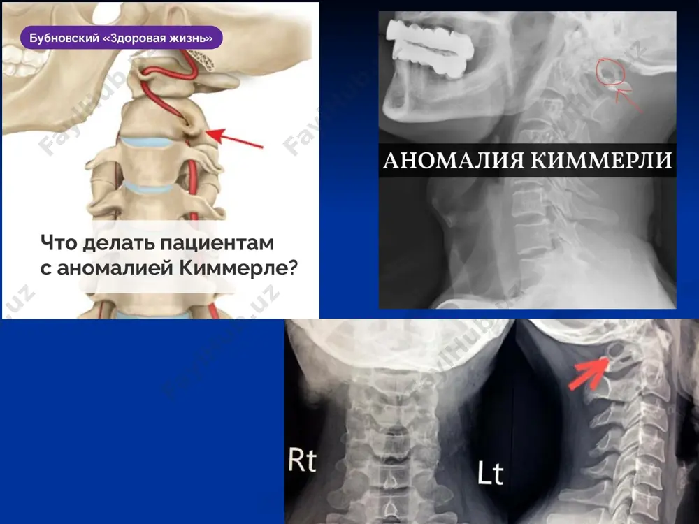o'zini namoyon qiladi . rizomonomeloreostoz- bu o'tkir skleroz , giperostoz va bir yoki bir nechta uzun naychali suyaklarning (femur, tibia, humerus ) deformatsiyasi bilan tavsiflangan tug'ma irsiy suyak kasalligi . ta'sir qilingan bo'g'imlarda og'riq , keyinchalik bo'g'imlarning harakatchanligini cheklash ; ko'pincha yumshoq to'qimalarning atrofiyasi va kalsifikatsiyasi ; mineral metabolizm normaldir . ta'sir qilingan ekstremitalarda kalsinozning rentgenologik-bo'ylama chiziqlari . 7. enkondromatoz- metafizalar va diafizlarda uzun naychali suyaklar yoki yassi suyaklar tanasida embrion organogenezida tushadigan to'qimalarning o'choqlari mavjudligi , shunga mos ravishda rentgenologik tekshiruvda turli shakl va o'lchamdagi patologik o'choqlari aniqlanadi . bu embrion ossifikatsiyasining sekinlashishi va buzilishiga asoslanadi , bu skeletini suyak to'qimasi bilan almashtirishning yo'qligidan iborat . suyak anomaliyalari nomukammal osteogenez ( nomukammal suyak shakllanishi ) – mezenxima etishmovchiligi bilan bog'liq suyak hosil bo'lish nuqsoniga asoslanadi . minimal shikastlanish bilan uzun naysimon suyaklar , qovurg'alar va umrovlarning sinishiga moyilligi bilan tavsiflanadi . bosh suyagi , tos suyagi va falanga suyaklarining …