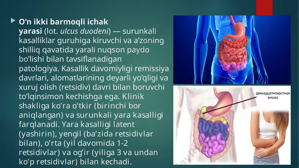 illar ham mavjud. unga quyidagilar kiradi: surunkali charchoq, stress, doimiy qo’zg’alganlik, depressiya, psixoloemotsional fonda buzilishlar; genetik darajada moyillik; me’da shirasi nordonligining oshib ketishi — bu holda u o’n ikki barmoqli ichakka kirib, shilliq qavatni qo’zg’atadi; o’n ikki barmoqli ichakda surunkali yallig’lanish jarayoni — duodenit; boshqa patologiyalar fonida immunitetning sezilarli darajada pasayishi; ba’zi dori-darmonlardan uzoq muddatli foydalanish — masalan, steroid / nosteroid yallig’lanishga qarshi (analgin, aspirin, diklofenak), antibakterial vositalar; chekish, ayniqsa och qoringa; gastrinoma; ovqatlanish ratsionining buzilishi. 12 barmoqlik ichak yarasi belgilari va alomatlari bolalar va qariyalarda yara kasalligi kechishi deyarli sezilmasligi mumkin. bu holat og’ir asoratlar rivojlanishiga olib keladi. kasallikning tipik alomatlaridan biri — xarakterli og’riq sindromidir. agar kasallik remissiya bosqichida bo’lsa, u bemorni bezovta qilmaydi, bemor normal turmush tarzini olib boradi. o’n ikki barmoqli ichak yarasining xuruj olishida quyidagi belgilar kuzatiladi: og’riq. jigildon qaynashi. qorin dam bôlishi kôngil aynishi. qayt qilish. ovqat hazm qilish tizimidagi buzulishlar. psixoemotsional buzilishlar — …