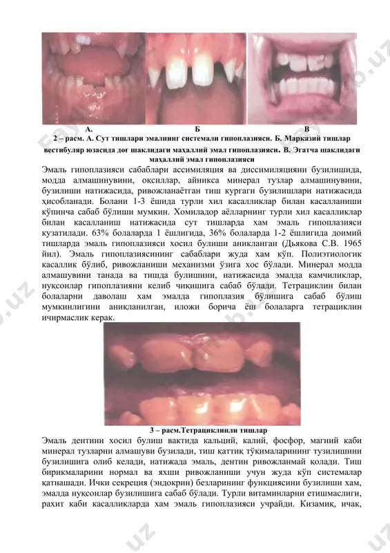 ллий эмал гипоплазияси. в. эгатча шаклидаги маҳаллий эмал гипоплазияси эмаль гипоплазияси сабаблари ассимиляция ва диссимиляцияни бузилишида, модда алмашинувини, оқсиллар, айникса минерал тузлар алмашинувини, бузилиши натижасида, ривожланаётган тиш кургаги бузилишлари натижасида ҳисобланади. болани 1-3 ёшида турли хил касалликлар билан касалланиши кўпинча сабаб бўлиши мумкин. хомиладор аёлларнинг турли хил касалликлар билан касалланиш натижасида сут тишларда хам эмаль гипоплазияси кузатилади. 63% болаларда 1 ёшлигида, 36% болаларда 1-2 ёшлигида доимий тишларда эмаль гипоплазияси хосил булиши аникланган (дьякова с.в. 1965 йил). эмаль гипоплазиясининг сабаблари жуда хам кўп. полиэтиологик касаллик бўлиб, ривожланиши механизми ўзига хос бўлади. минерал модда алмашувини танада ва тишда булишини, натижасида эмалда камчиликлар, нуқсонлар гипоплазияни келиб чиқишига сабаб бўлади. тетрациклин билан болаларни даволаш хам эмалда гипоплазия бўлишига сабаб бўлиш мумкинлигини аниқланилган, иложи борича ёш болаларга тетрациклин ичирмаслик керак. 3 – расм.тетрациклинли тишлар эмаль дентини хосил булиш вактида кальций, калий, фосфор, магний каби минерал тузларни алмашуви бузилади, тиш қаттиқ тўқималарининг тузилишини бузилишига олиб келади, …