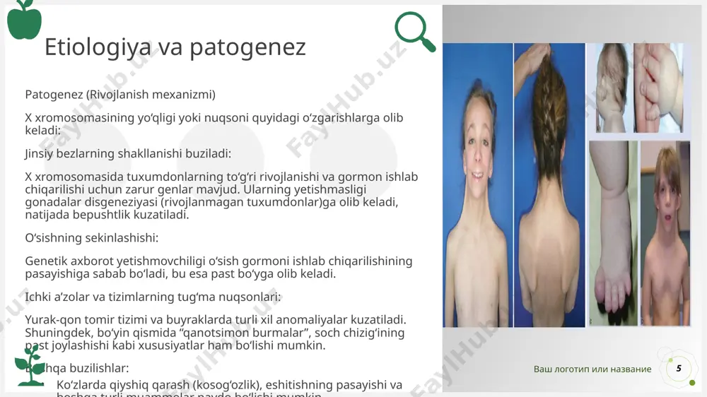 ammo o‘z vaqtida o‘sish gormoni va estrogen terapiyasi qo‘llansa, ko‘p hollarda bo‘y va ikkilamchi jinsiy belgilar yaxshilanadi.reproduktiv prognoz: ko‘pchilikda tuxumdonlar yetilmaydi (gonadal disgenez). shuning uchun tabiiy yo‘l bilan homilador bo‘lish juda qiyin yoki imkonsiz. lekin donor tuxum hujayra va sun’iy urug‘lantirish yordamida homiladorlikka erishish mumkin. bunday homiladorliklar doimo yuqori xavfli hisoblanadi.ijtimoiy moslashuv: intellekt odatda saqlanib qoladi, shuning uchun ta’lim olish, ishlash, oilaviy hayot kechirish imkoniyatlari yaxshi. psixologik qo‘llab-quvvatlash muhim. ваш логотип или название profilaktika 14 birlamchi profilaktika (kasallikni oldini olish): bu sindrom xromosoma anomaliyasi bilan bog‘liq bo‘lgani uchun uni oldini olishning mutlaq yo‘li yo‘q. lekin xavf guruhidagi oilalarda (masalan, genetik kasalliklarga ega oilalarda) genetik maslahat tavsiya qilinadi. ikkinlamchi profilaktika (erta aniqlash va davolash orqali asoratlarni kamaytirish): homiladorlik davrida prenatal diagnostika (uzi, invaziv genetik testlar) yordamida aniqlash. bolalikdan boshlab muntazam kardiolog, endokrinolog, ginekolog va nefrolog kuzatuvida bo‘lish. o‘sish gormoni terapiyasi – bo‘y pastligini kamaytiradi. estrogen va progesteron terapiyasi – ikkilamchi jinsiy …