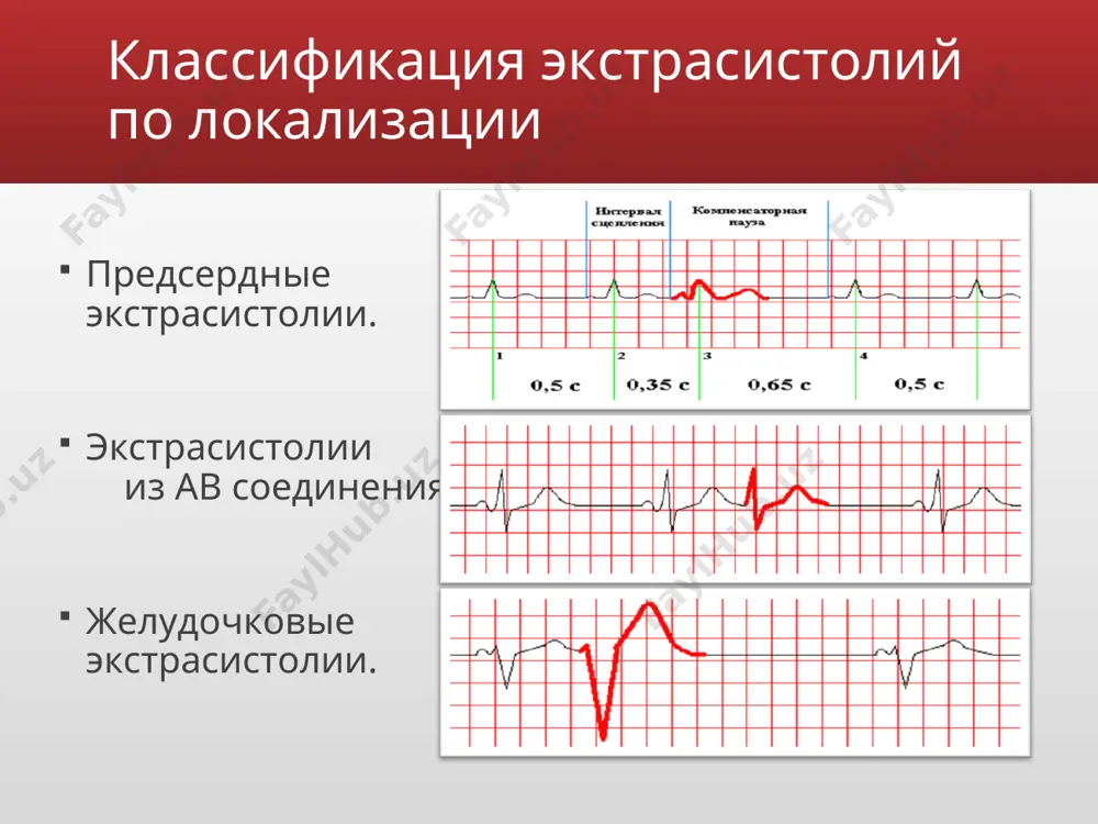 постэкстрасистолического интервала меньше двух нормальных интервалов rr). предсердные экстрасистолы электрокардиограмма во втором отведении при предсердной экстрасистолии электрокардиограмма во втором отведении при предсердной экстрасистолии а — типичная предсердная экстрасистола, из-за преждевременности появления экстрасистолы зубец р наслаивается на зубец т предыдущего нормального комплекса, интервал r3—r5 меньше интервала r1—r3 (неполная компенсаторная пауза) б — предсердная экстрасистола с аберрантным проведением по желудочкам, по форме она напоминает желудочковую экстрасистолу, отличаясь от нее наличием зубца р, который наслаивается на зубец т предыдущего нормального комплекса (т + р), меняя его конфигурацию, и неполной компенсаторной паузой (интервал r3—r5 меньше интервала r1—r3) в — блокированная предсердная экстрасистола (указана стрелкой); после нормального желудочкового комплекса преждевременно появляется зубец р экстрасистолы, не сопровождающийся желудочковым комплексом (отсутствующий комплекс обозначен как r4); интервал r3—r5, меньше интервала r1—r3 (неполная компенсаторная пауза). р — предсердный зубец; qrst — желудочковый комплекс; цифровые обозначения зубцов r (r1, r2, r3 и т.д.) соответствуют последовательным желудочковым комплексам (включая экстрасистолические). диагностика …