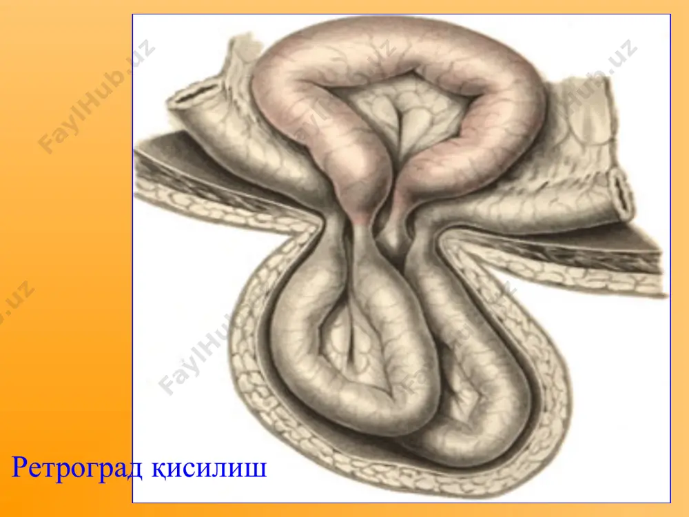 қорин чурраларининг асоратлари - Page 4