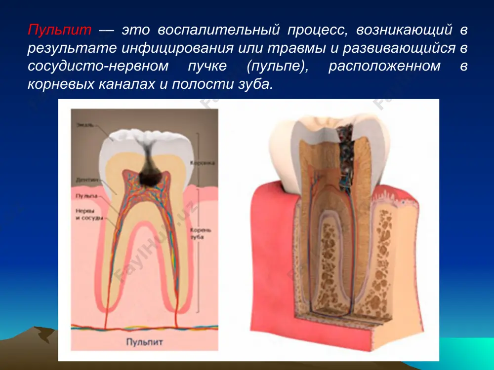 собенно от холодного; 2). пациент точно указывает на больной зуб, иррадиация болей отсутствует; 3). имеется глубокая кариозная полость, полость зуба в обоих случаях не вскрыта. различия: 1). при остром очаговом пульпите боли могут возникать от более слабых раздражителей и не проходят сразу после устранения причины. часто имеют место самопроизвольные боли с длинными безболевыми промежутками; 2). зондирование при остром очаговом пульпите резко болезненно в проекции воспаленного рога пульпы, а при глубоком кариесе менее интенсивная болезненность выявляется по дентино-эмалевой границе и всему дну кариозной полости. дифференциальная диагностика острого очагового и острого диффузного пульпита 1). при остром очаговом пульпите боли чаще возникают от холодного, а при остром диффузном пульпите при переходе в гнойную стадию боли появляются преимущественно от горячего. холод боль успокаивается; 2). при остром очаговом пульпите безболевые промежутки гораздо длиннее болевых, а при остром диффузном пульпите самопроизвольные боли длительные (до нескольких часов), а промежутки короткие; 3). острый очаговый пульпит существует не более …