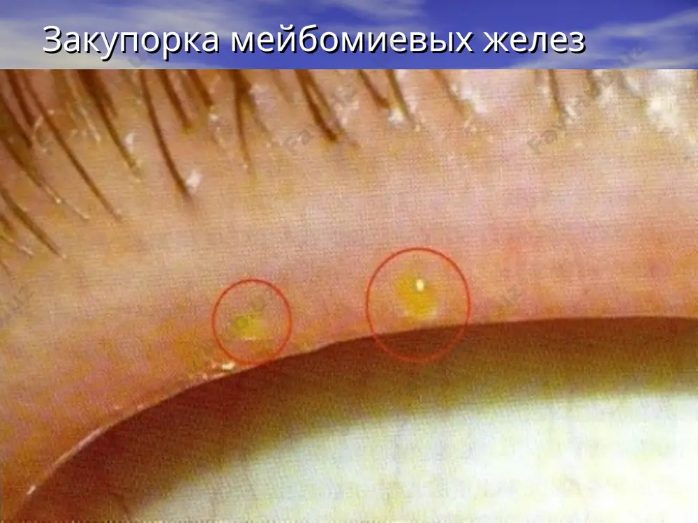 trabekul. diametr xalyaziona snachala sostavlyaet okolo 5-6 mm, odnako postepenno on uvelichivaetsya v razmere, v svyazi s chem proisxodit davlenie na glaznoe yabloko. poslednee mojet soprovojdatsya astigmatizmom. pri razvitii xalyaziona patsienti jaluyutsya na novoobrazovanie na nijnem ili verxnem veke, kotoroe medlenno uvelichivaetsya v razmere. zrenie ne izmenyaetsya, za isklyucheniem sluchaev, kogda xalyazion nastolko bolshoy, chto okazivaet davlenie na rogovitsu, provotsiruya astigmatizm. v osnovnom, patsientov bespokoit kosmeticheskiy defekt. pri osmotre v tolshe veka obnarujivaetsya plotnoe okrugloe obrazovanie razmerom ot prosyanogo zerna do nebolshoy goroshini bezboleznennoe pri palpatsii, pokrito neizmenennoy. obrazovanie ne spayano s okrujayushimi tkanyami, koja nad nim podvijna. pri issledovanii vnutrenney poverxnosti veka nablyudaetsya lokalnaya giperemiya. prisoedinenie mikrobnoy flori mojet vizvat gnoynoe vospalenie xalyaziona – abstsedirovanie. pri etom koja nad xalyazionom krasneet, vokrug kapsuli ego nablyudaetsya otek tkaney veka. xalyazion mojet samoproizvolno vskritsya, inogda obrazuetsya svish – kanal mejdu polostyu xalyaziona i poverxnostyu koji. vokrug svishevogo otverstiya obnarujivayutsya granulyatsii – …