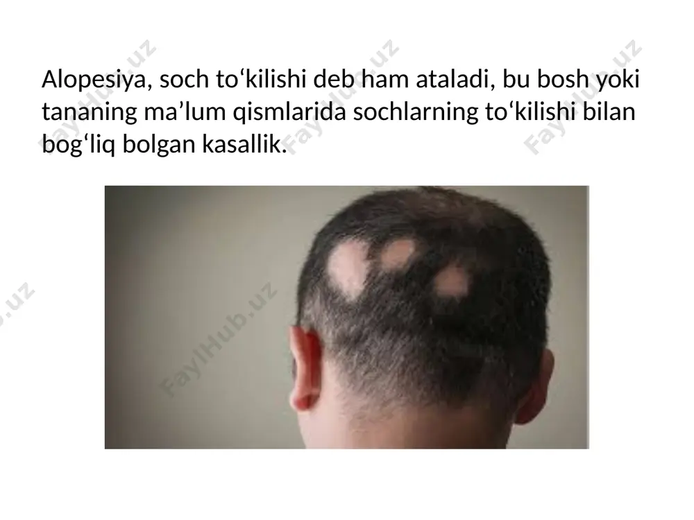 yangi sochlar o'sib chiqishi va shu vaqtning o'zida yangi sochsiz o'choqlar rivojlanishi mumkin. agarda kasallik avjlanishi davom etaversa, total alopetsiyaga o'tishi mumkin. ayrim hollarda bemor tirnog'ida mayda teshiksimon o'zgarishlar paydo bo'lib, u angishvonani eslatadi. totalalopetsiya (alopecia totalis) ayrim holatlarda tug'm a bo'ladi va nafaqat boshda sochlar bo'lmaydi, hatto qosh, soqol va kipriklar ham bo'lmaydi. k o'p bemorlaming ikkilamchi tuklanuvchi sohalarida ham sochlar o'smaydi. terida soch qopchalari rivojlanmaganligi sababli teri silliq, yaltiroq bo'ladi. universalalopetsiya (alopecia universalis) o'choqli soch to'kilishining yakunlanuvchi davri bo'lib, mustaqil kasallik holida juda kam uchraydi. universal alopetsiya og'ir yuqumli kasalliklarda (tif), ionizatsiyalanuvchi nurlar bilan nurlanganlarda, turli intoksikatsiyalardan so'ng va zamburug'simon mikozning eritrodermik turi (sezari sindromi) da kuzatiladi. androgen soch to‘kilishi (alopecia androgenica) ko'proq nasliy moyillik bor erkaklarda kuzatiladi, jarayon androgenlarning soch follikulasiga bo'lgan tasiri natijasida peshona yoki ensa sohasidan boshlanadi, o'ziga xos klinik ko'rinishga ega. soch to'kilgan teri qismi yaltirab, silliq ko'rinishda bo'ladi, follikulalar teshikchalari ko'zga ko'rinmaydi. ko'p …