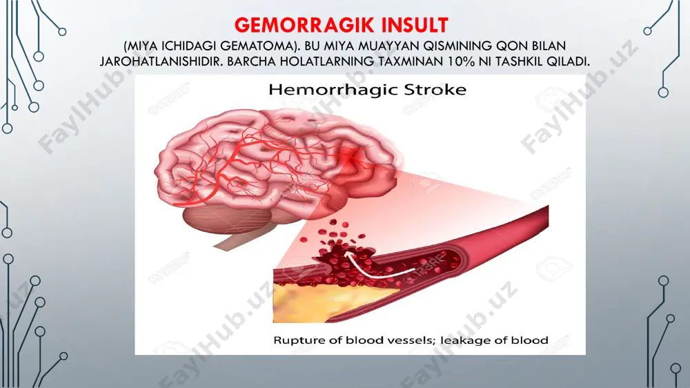 te’mol qilish va chekish insult uchun muhim provokatsion omil hisoblanadi. sigaret va spirtli ichimlik birgalikda yurak-qon tomir kasalliklarini rivojlanish ehtimolini sezilarli darajada oshiradi va bu o’z navbatida insultning yuzaga kelishiga yordam beradi. • boshqa kasalliklar: qandli diabet, arterial gipertoniya, fabri kasalligi, periferik tomirlar kasalligi, uyqu arteriyalarining stenozi, boshqa yurak-tomir kasalliklari. tasnifi bir necha turdagi insult farqlanadi: • ishemik insult (miya infarkti). bu eng ko’p uchraydigan turi bo’lib, u taxminan 80% holatlarni tashkil qiladi. ushbu turdagi insult miyaning muayyan hududida qon aylanishining keskin tanqisligi hisoblanadi. • gemorragik insult (miya ichidagi gematoma). bu miya muayyan qismining qon bilan jarohatlanishidir. barcha holatlarning taxminan 10% ni tashkil qiladi. • subaraxnoidal qon ketishi. bu holat miya qon tomirlarining yorilishi natijasida rivojlanadi. subaraxnoidal qon ketish barcha holatlarning taxminan 5% ni tashkil etadi.keng tarqalgan insult. bu massiv insultlarni birlashtiradigan atama. • keng tarqalgan insult og’ir insult turiga xos bo’lib, umumiy miya alomatlari bilan namoyon bo’ladi.lakunar insult. bu …