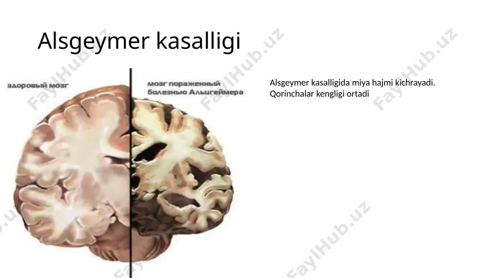 lmaydi. o'lim odatda altsgeymer kasalligining o'zi emas, balki bosim yarasi yoki pnevmoniya kabi tashqi omillarga bog'liq. patologik mexanizmi beta-amiloid peptidlarning sintezining buzilishi va keyinchalik to'planishi altsgeymer kasalligida patologik anomaliyalarni qanday keltirib chiqarishi aniq ma'lum emas. amiloid gipotezasi an'anaviy ravishda beta-amiloidning to'planishini neyron degeneratsiyasi jarayonini qo'zg'atuvchi asosiy hodisa sifatida ko'rsatdi. cho'kmalar hujayradagi kaltsiy ionlarining gomeostazini buzadi va apoptozni qo'zg'atadi, deb ishoniladi. ma'lumki, mitoxondriya bemorlarning neyronlarida ab to'playdi va bu peptid ham ma'lum fermentlarning ishini inhibe qiladi va glyukozadan foydalanishga ta'sir qiladi.patofiziologiyada yallig'lanish jarayonlari va sitokinlar rol o'ynashi mumkin. yallig'lanish har qanday kasallikda to'qimalarning shikastlanishining belgisi bo'lganligi sababli, altsgeymer kasalligida u asosiy patologiyaga nisbatan ikkinchi darajali rol o'ynashi yoki immunitet reaktsiyasining belgisi bo'lishi mumkin. e’tiboringiz uchun rahmat image1.jpeg image2.jpeg image3.jpeg image4.jpeg /docprops/thumbnail.jpeg