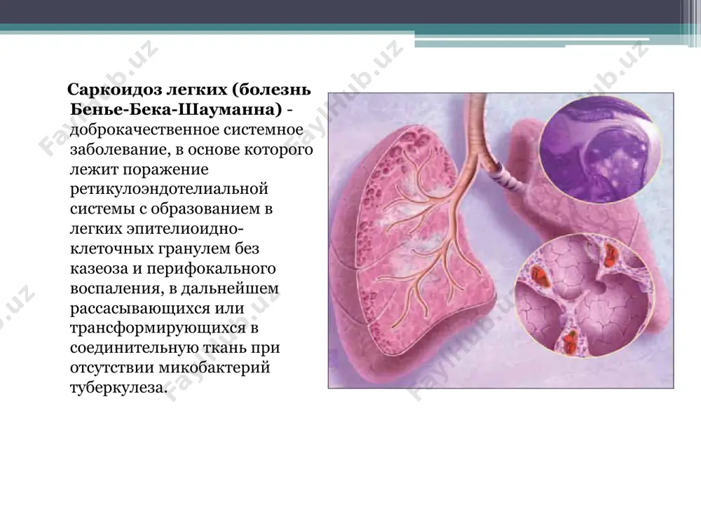 больных); снижение массы тела; увеличение периферических лимфатических узлов (у половины больных); лимфаденопатия средостения (чаще двухсторонняя); узловатая эритема; синдром лефгрена; синдром хеерфордта-вальденстрема; сухие хрипы при аускультации легких. при саркоидозе легких поражаются: лимфатические узлы; бронхопульмональная система; система органов пищеварения; селезенка; сердце; почки; костный мозг; костно-суставная система; эндокринная система; нервная система; кожа; орган зрения. диагностика общие анализы крови, мочи. биохимический анализ крови. иммунологические исследования. исследование бронхиальной лаважной жидкости. рентгенологическое исследование легких. спирография. кт. бронхоскопия. биопсия и гистологическое исследование биоптатов лимфоузлов и легочной ткани, полученных при трансбронхиальной или открытой биопсии легких. общий анализ крови и мочи общий анализ крови: увеличение соэ лейкоцитоз у 20% больных отмечается эозинофилия, у 50% - абсолютная лимфопения. общий анализ мочи: без существенных изменений. биохимический анализ крови повышение уровней серомукоида, гаптоглобина, сиаловых кислот, гамма-глобулинов; у 15-20% больных увеличено содержание кальция в крови; повышение уровня общего или связанного с белком оксипролина; ангиотензинпревращающего фермента; повышение содержания в крови лизоцима. иммунологические исследования снижение …