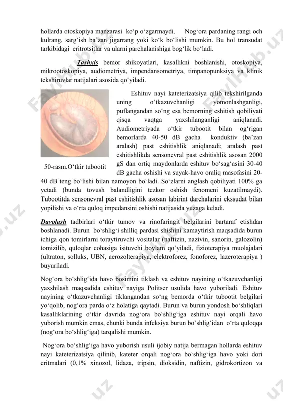 i; esnaganda,aksirganda eshitish qobiliyati qisqa vaqtga yaxshilanishini ta’kidlaydi. bemorning umumiy ahvoli o‘zgarmaydi, tana harorati me’yorda yoki subfebril bo‘ladi, qulog‘i og‘rimaydi. otoskopiyada nog‘ora pardani ichkariga botganligi va xiralashganligi; bolg‘acha dastasi kalta, tashqi o‘simtasi esa bo‘rtgan bo‘li ko‘rinadi, nog‘ora pardaning old va orqa burmalari ko‘zga tashlanib turadi. yorug‘lik konusi to‘g‘ri chiziq shaklida ko‘rinadi (me’yorda u uchburchak shaklda bo‘ladi). nog‘ora parda ichkariga yanada chuqur botgan hollarda yorug‘lik konusi ko‘rinmay qoladi (50-rasm). yallig‘lanish jarayoni eshituv nayidan nog‘ora bo‘shlig‘iga tarqalmagan hollarda otoskopiya manzarasi ko‘p o‘zgarmaydi. nog‘ora pardaning rangi och kulrang, sarg‘ish ba’zan jigarrang yoki ko‘k bo‘lishi mumkin. bu hol transudat tarkibidagi eritrotsitlar va ularni parchalanishiga bog‘lik bo‘ladi. tashxis bemor shikoyatlari, kasallikni boshlanishi, otoskopiya, mikrootoskopiya, audiometriya, impendansometriya, timpanopunksiya va klinik tekshiruvlar natijalari asosida qo‘yiladi. 50-rasm.o‘tkir tubootit eshituv nayi kateterizatsiya qilib tekshirilganda uning o‘tkazuvchanligi yomonlashganligi, puflangandan so‘ng esa bemorning eshitish qobiliyati qisqa vaqtga yaxshilanganligi aniqlanadi. audiometriyada o‘tkir tubootit bilan og‘rigan bemorlarda 40-50 db gacha konduktiv (ba’zan aralash) …