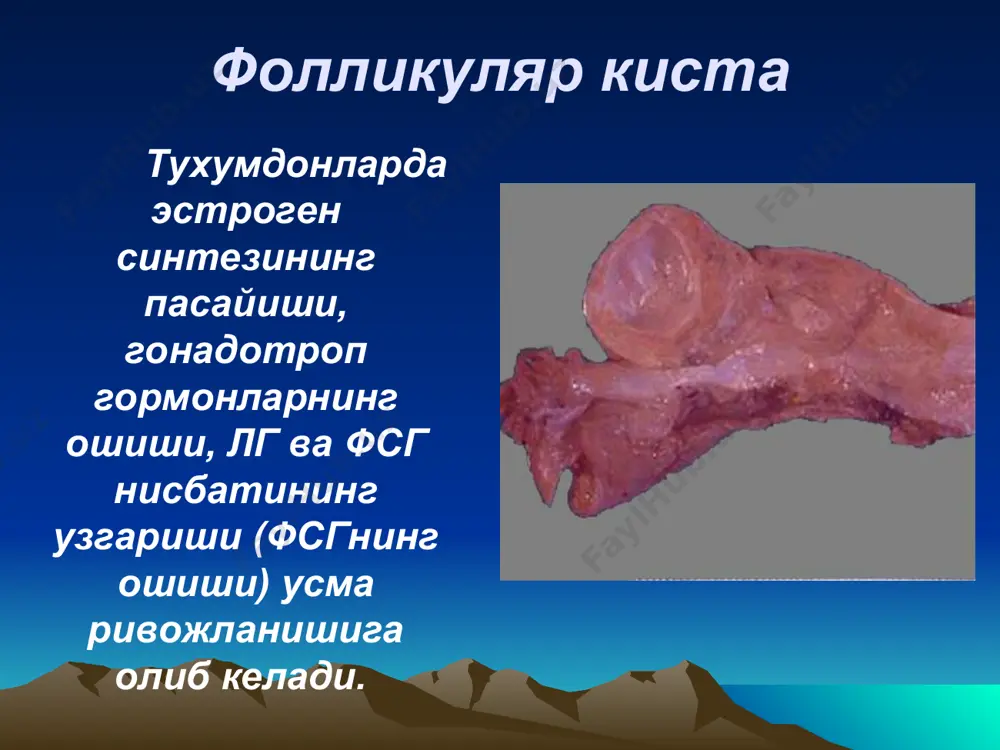 axshi sifatli usmani uzini olib tashlab, aktiv kuzatuvga olish kerak. postmenopauza davrida kursatma bachadaon va uning ortiklari bilan olib tashlash. yomon sifatli usmalarda bachadon va uning ortiklari bilan olib tashlash va charvini rezektsiyasi. usmanig iii va iv boskichlarida ximioterapiya (tiofosfamid) kullash. jarroxlik aralashuvlari vaktida usma xarakterini bilish uchun zudlik bilan morfologik tekshirishga yuborib kup kasallarda operatsiya xajmini xal kilish. usma tuzilishi anatomik oyokchalar xirurgik oyokchalar ushlab turuvchi boylam tuxumdon xususiy boylamlari keng boylam kismlari, bachadon arteriyasi va limfa tugunlar,nervlar anatomik xosila , operatsiya vaktida kesiladi (anatomik oyokcha,bachadon naylari ,charvi) kista oyokchalarining buralishi kup xollarda uchraydi birdaniga keskin xarakat kilganda,ogir narsa kutarganda.; bu asorat kupincha kizlarda kuzatiladi. asoratlar kista oyokchasini buralishi kapsulaning yorilishi yiringlashi xosilaning tugri ichak va siydik pufagiga ochilishi kista oyokchasining buralishi utkir korin klinikasi kungil aynish kusish korin old devorining taranglashuvi, shetkina - blyumberg simptomi musbat bulishi pulsni tezlashishi xaroratni kutarilishi birdan kuchli ogrikni paydo bulishi klinika asoratlar …