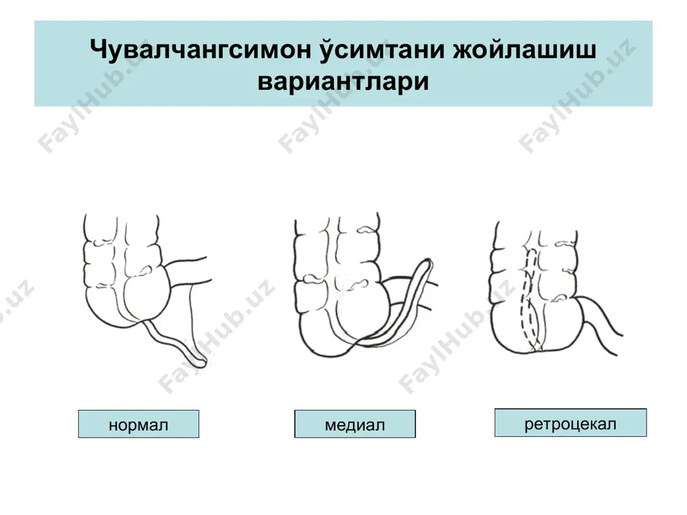 ўткир аппендицит - чувалчангсимон ўсимтанинг ўткир носпецефик яллиғланиши - Page 3