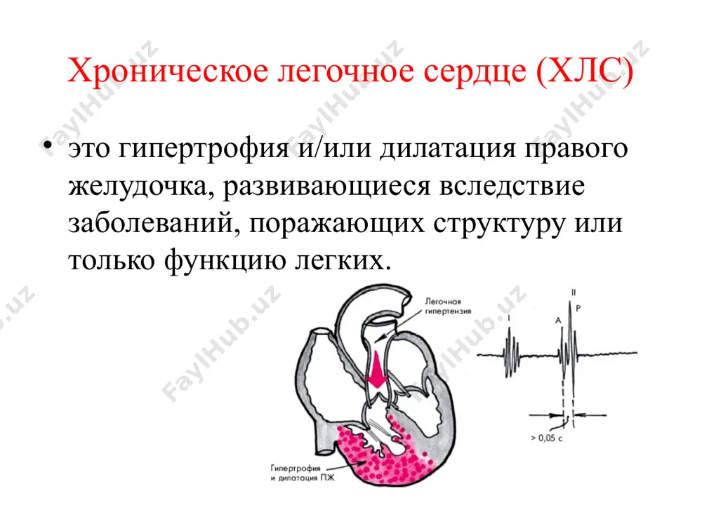. v pokoe i vishe 30 mm rt. st. pri fizicheskoy nagruzke. morfologicheskim priznakom xls yavlyaetsya utolshenie stenki pravogo jeludochka bolee 5 mm. stepen gipertrofii miokarda pravogo jeludochka opredelyayut v zavisimosti ot tolshini stenok kak slabuyu (5–6 mm), umerennuyu (6–8 mm) i virajennuyu (bolee 8 mm). simptomi xronicheskogo legochnogo serdtsa pri tuberkuleze klinicheskaya kartina zabolevaniya vklyuchaet simptomi osnovnogo protsessa i priznaki lyogochno-serdechnoy nedostatochnosti. na rannix stadiyax dominiruyut simptomi intoksikatsii ili dixatelnoy nedostatochnosti: kashel, odishka, povishenie temperaturi tela. vajniy simptom - «tyopliy» tsianoz (sledstvie arterialnoy gipoksemii), intensivnost tsianoza sootvetstvuet stepeni virajennosti respiratornix rasstroystv i stepeni dixatelnoy nedostatochnosti. golovokrujenie, golovnie boli, sonlivost i sjimayushie pristupoobraznie boli v oblasti serdtsa. po mere uvelicheniya pravix otdelov serdtsa vozmojno vozniknovenie «anginoznix boley» vsledstvie sdavleniya levoy koronarnoy arterii uvelichennim lyogochnim stvolom. bolnie s lyogochno-serdechnoy nedostatochnostyu i stadii mogut dlitelnoe vremya ostavatsya v sostoyanii polnoy kompensatsii. prodoljayusheesya vozdeystvie mikobakteriy privodit k dekompensatsii. stepeni dekompensatsii pri i stepeni …