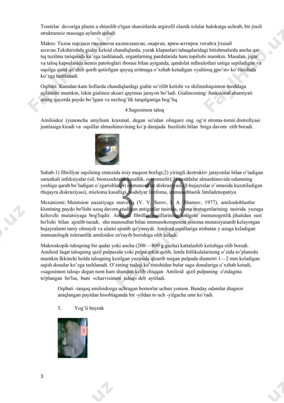 ko'p darajada izdan chiqadigan bo'lsa, bu holda jigardagi yog' distrofiyasi, y ani yog' gepatozi tabiatan qaytmas tusga kiradi. shunday qilib, ichkilikboz odam , ya`ni alkogolik jigarda hali sirroz boshlanmasdan turib, ichkilik ichishga barham beradigan bo'lsa, u holda kasallik jarayonining orqaga qaytib, jigarning tuzilishi bilan funktsiyalari to`la-to'kis tiklanishi, asliga kelishini kuzatish mumkin. 3. sirlangan taloq gialinoz - biriktiruvchi to`qimada va tomirlar devorida pushti raneli shishasimon qattiqqina gomogen modda to'planib qolishidir. sabablari: коллагенозлар.ревматик касалликлар.аутоиммун касалликлар.аллергик касалликлар.атеросклероз.гипертония касаллиги.васкулитлар.диабетик ангиопатиялар mexanizmi: gialinoz boshlanishi mexanizmi asosida quyidagi omillar yotadi: 1) argirofil membranalar, endoteliyi va silliq muskul hujayralarining zararlanishi, 2) tomirlar devorining plazma oqsillari uchun o‘ta o'tkazuvchan bo'lib qolishi, bu narsa plazmorragiyaga olib boradi, 3) tomirlar devoridagi tolali tu zilmalarning fizik-kimyoviy o'zgarishlari,4) o‘zgarib qolgan tolali tuzilmalarga plazma oqsillari adsorblanib, keyinchalik fibrillyar oqsil — gialin hosil bo'lishi va cho'kib tushishi. tomirlar devoriga plazm a shimilib o'tgan sharoitlarda argirofil elastik tolalar halokatga uchrab, bir jinsli strukturasiz massaga aylanib …