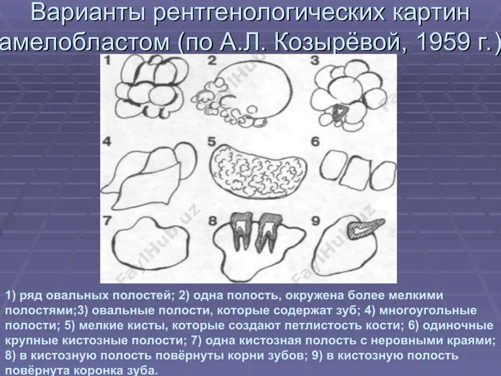 гиперплазия). видно плотную коллагеновую соединительную ткань. эпулис (воспалительная фиброзная гиперплазия). микрофотография демонстрирует фиброзную гиперплазию с заметной фиссурой. врождённый эпулис новорождённого. эпулис на альвеолярном отростке нижней челюсти. фиброматозный эпулис.