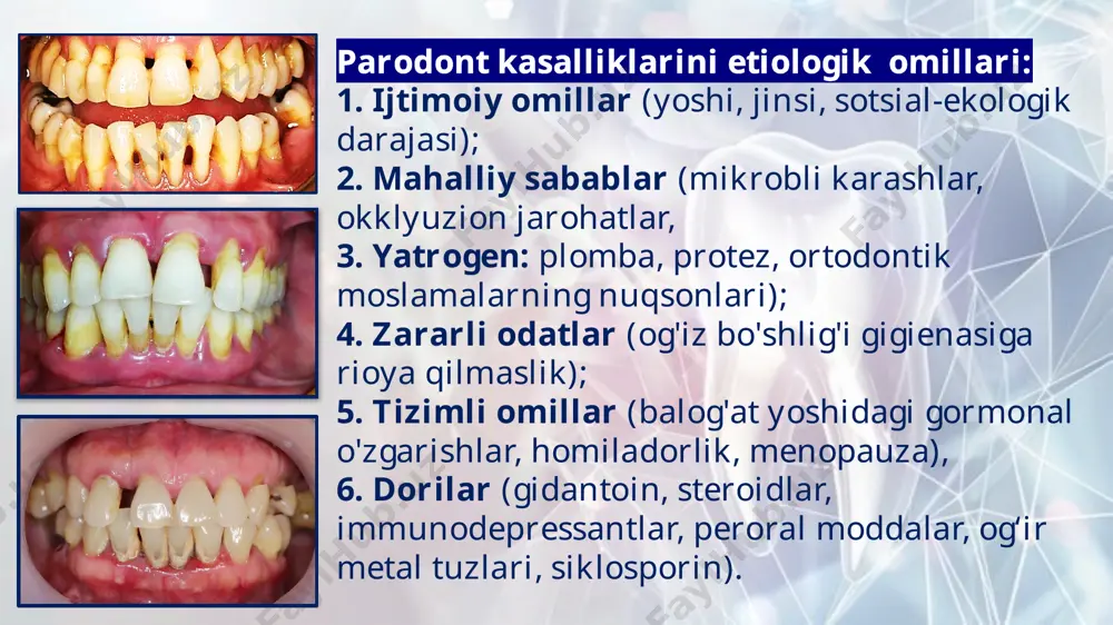 so‘zi — “qavatlanib to‘kilish” degan ma’noni bildiradi. bemor shikoyatlari: milkda achishish va og‘riq (ayniqsa issiq, sovuq va achchiq ovqat iste’mol qilganda) milkning sezgirligi yuqori bo‘lishi og‘izdan yoqimsiz hid ba’zan qonash klinik belgilar: milk yuzasida epiteliy qatlamining qavat-qavat to‘kilishi (deskvamatsiya) shilliq qavat yupqalashib, och-sarg‘ish yoki qizil rangli joylar paydo bo‘ladi eroziyalar va yallig‘langan o‘choqlar kuzatiladi ko‘pincha milkning oldingi qismida (frontal sohada) ko‘rinadi periodontal cho‘ntaklar odatda bo‘lmaydi tish yuzasida blyashka bo‘lishi mumkin 1. kataral gingivit davolash asosiy maqsad – milkdagi yallig‘lanishni kamaytirish, blyashka va tish toshini yo‘qotish. davolash bosqichlari: professional gigiena – tish toshi va blyashkani tozalash. antiseptik chayishlar – xlorheksidin 0,05–0,12%, furatsillin, miramistin bilan og‘izni chayish. mahalliy davolash – stomatologik gellar (metrogil-denta, holisal) milk ustiga surtiladi. umumiy davolash – c va b guruhi vitaminlari, immunitetni mustahkamlovchi preparatlar. qo‘shimcha – milk massaji, fizioterapiya. 2. gipertrofik gingivit davolash asosiy maqsad – milk giperplaziyasini kamaytirish va estetik funksiyani tiklash. davolash bosqichlari: gigiena – tish …