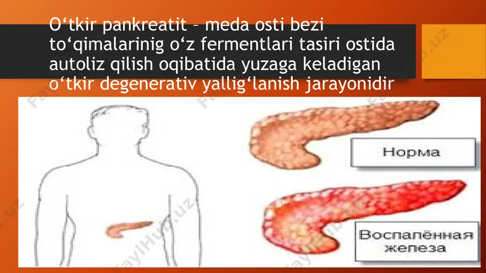 pankreatit haqida prezentatsiya - Page 5