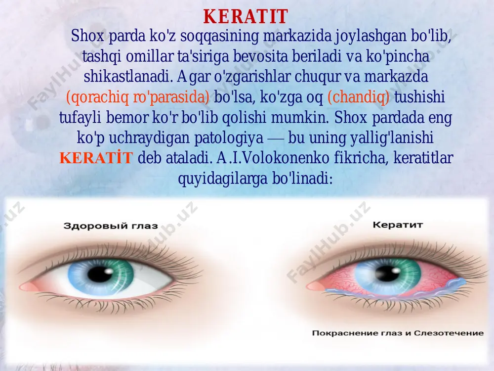 iqlik, silliqlik, yaltiroq-oynasimonlik, qon tomiri yo'qligi, o'ta sezuvchanlik o'zgaradi (kulrang yoki sarg'ish rang infiltrat yuzasi g'adir-budur bo'lib, u yaltiramaydi, qon tomirlar atrofdagi qismlardan shox pardaga kirib kelishi mumkin) shox pardaning o'rmalovchi yarasi — (ulcus cornea serpens) bu shox pardaning og'ir yallig'lanishli yaralanishidir. odatda to'satdan ko'zda kuchli sanchiq, yoshlanish va og'riq bilan, shox pardaning o'rtasida dumaloq sarg'ish-kulrang infiltrat paydo bo'lishi bilan boshlanadi. uning sathidagi epiteliy biroz notekis bo'ladi. infiltrat tezda yorilib, yara paydo qiladi. yara atrofida shox parda xiralashadi. asosiy belgilari shundan iboratki, yaraning ko'z tirqishi yo'nalishidagi bir tomoni anchagina chuqurlashib, sap-sariq yiring boylaydi va tobora chuqurlashib, 1-2 kun ichida pardaning tiniq tomoniga surilib ketaveradi. yaraning ikkinchi, regressiv tomoni esa yiringdan tozalanadi va epiteliysi paydo bo'ladi. yallig'lanish jarayoni kuchayib, yiring tez orada ko'z ichiga suriladi. ko'z oldingi kamerasida yiring — gipopion (hypopion) paydo bo'lishi bilan birga, undagi suyuqlik ham yiringli loyqalanadi. rangdor parda yallig'lanishi mumkin. yara borgan sari chuqurlashib, ko'pincha yoriladi …