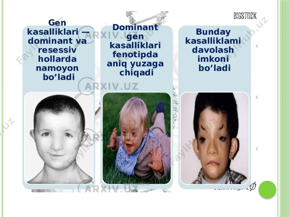 siklin antibiotiklaridan foydalanish yangi tug'ilgan chaqaloqlarda kataraktaga olib kelishi mumkin. ob'ektiv shaffofligini ta'minlash uchun tug'ma katarakt rivojlanishiga sabab bo'ladigan oqsillar tarkibidagi genetik o'zgarishlar. tug'ma kataraktalar ko'zning barcha rivojlanish anomaliyalarining 60% ni tashkil qiladi va yangi tug'ilgan chaqaloqlarning taxminan 0,4% da uchraydi. tug'ma kataraktlarning aksariyati jarrohlik uchun ko'rsatma, lekin ba'zi hollarda, linzalarning shaffofligi periferik bo'lsa va markaziy ko'rishni kamaytirmasa, jarrohlik davolash talab qilinmaydi. marfan sindromi (yoki araxnodaktiliya) - biriktiruvchi to'qima yetishmasligi bilan tavsiflanadigan irsiy kasallik marfan sindromi fibrilin oqsil genining 15 -xromosomasining mutatsiyasidan kelib chiqadi, buning natijasida kollagen tuzilishi va ishlab chiqarilishi buziladi. kasallik yurak -qon tomir, asab, mushak -skelet va boshqa tizim va organlarda patologik o'zgarishlarga olib keladi araxnodaktiliya autosomal -dominant tarzda meros qilib olingan, shuning uchun u erkak va ayollarda deyarli bir xil nisbatda uchraydi. bu 1: 5000 tez -tez uchraydigan juda kam uchraydigan genetik kasallik. tabut-lovi sindromi-skeletning o'zgarishi, o'sishning kechikishi, eshitishning buzilishi bilan kechadigan x-ga bog'liq aqliy zaiflikning …