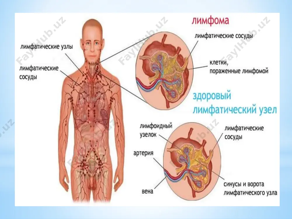 лы лимфома фолликулярлы лимфома аралас лимфома. орта дәрежелі 1.фолликулярлы лимфома 2.жайылмалы лимфома 3.жайылмалы аралас лимфома 4. жайылмалы улкен жасушалы лимфома жоғары дәрежелі 1.иммунобласты үлкен жафшалы лимфома 2.лимфобласты лимфома 3.беркитті лимфома әртүрлі саңырауқұлақ тәрізді лейкоз гистоцитоз экстрамедулярлы плазмоцитома жіктелмейтін және басқалар ходжкиндік емес лимфомалардың түрлері: 1. нодулярлы; 2. лимфоцитарлы; 3. лимфоцитарлы; 4. пролимфоцитарлы. лимфоманың жалпы белгілері: 1. лимфа түйіндерінің ұлғаюы; 2. терінің қышуы; 3. тершеңдік; 4. жалпы әлсіздік; 5. кеудеаралық лимфа түйіндерінің зақымдануынан болатын жөтел; 6. құрсақ қуысындағы лимфа түйіндерінің зақымдануынан болатын іштің ауыру сезімі, т.б. жалпы симптомдары:  мойын аумағындағы, қолтық астында немесе шаптың аумағында лимфа түйіндерінің ауырсынбайтын ісінуі  қызба (температураның артуы) және қалтырау  түнгі терлеу  салмақ жоғалту  тәбет жоғалту  терінің қышуы басқа симптомдары:  терідегі қызыл дақтар  жүрек айнуы, құсу, іштегі ауырсыну  жөтел немесе ентігу. кейбір адамдарда b-симптомдары пайда болады, олар:  түнгі терлеу  салмақты кенет жоғалту, әдетте, дене салмағынан 10%-дан …