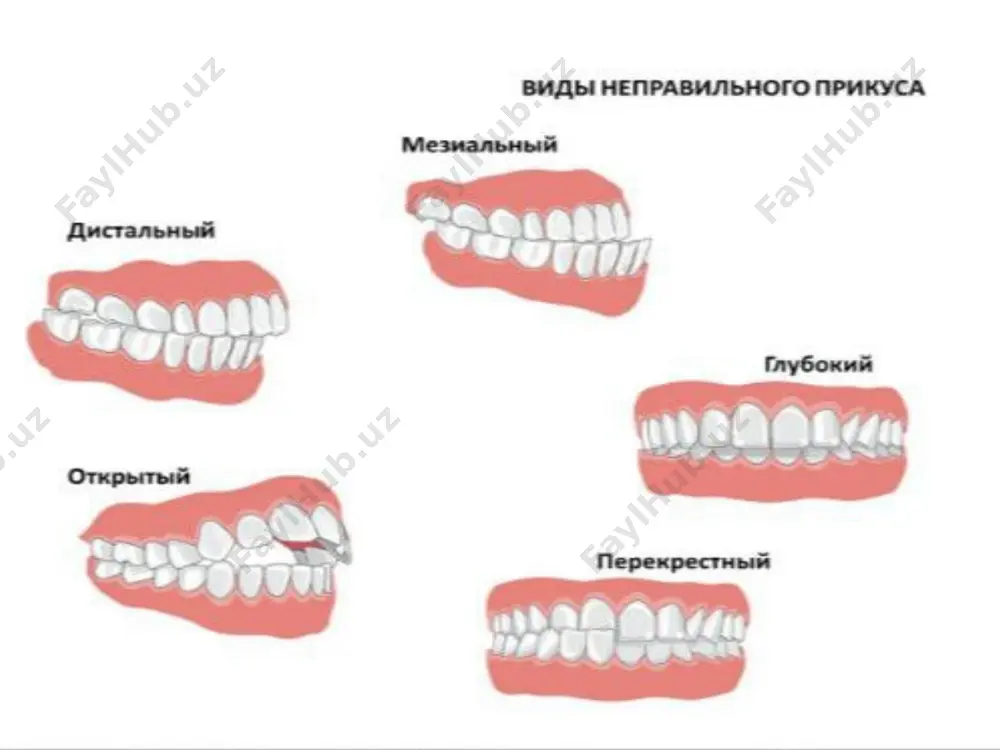 ингичкалашган юмшоқ танглай: қисқа юмшоқ танглай, унинг ёриқлиги, иккига бўлинган увула, унинг йўқлиги. нутқ терапияси амалиётида артикулятсия аппарати тузилишида аномалиялари бўлган болалар тез-тез учрайди. артикулятсион аппаратнинг мотор қобилиятини текшириш сокин пайтида юз мушакларининг ҳолатини кузатиш билан бошланади: бурун оғиз учбурчагининг бурмаларнинг ифодалилиги ва уларнинг симметрияси, лаблар чизиғининг табиати ва уларни ёпиш зичлиги қайд этилади. гиперкинезлар мавжудлиги аниқланади. биргаликдаги ҳаракатлар (синкинезиялар) мавжудлиги, бурун лаб бурмаларининг ассиметриклиги аниқланади. юз мушакларининг функтсияларини ўрганиш, айниқса, дизартия нутқ нуқсони бўлган болаларни текшириш ва ушбу маълумотлардан коррекцион ишларида фойдаланиш учун жуда муҳимдир. фонематик идрокни текшириш оддий ибораларни аниқлаш, фарқлаш ва таққослаш; бошқалар орасида маълум сўзларни танлаш ва ёдлаш (овоз таркибига ўхшаш, товуш таркиби бўйича фарқли); алоҳида товушларни турли товушлар кетма-кетлигида, сўнгра бўғинларда ва сўзларда ажратиш (овоз таркиби жиҳатидан фарқ қилади, овоз таркибига ўхшаш); 2-4 элементдан ташкил топган бўғинли қаторларни эслаб қолиш (унли товушни ўзгартириш билан: ма-ме-му, ундошнинг ўзгариши билан: ка-ва-та, па-ба-па); товушли қаторларни эёдда тутиш. image2.png …