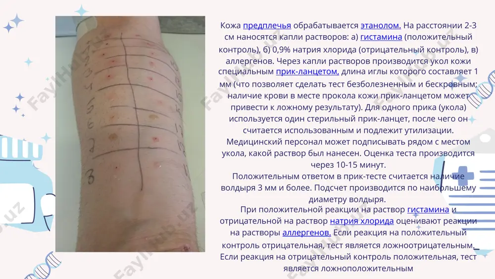 ornix testov v nastoyashee vremya naibolee sovremennim i tochnim issledovaniem yavlyaetsya opredelenie ige spetsificheskix antitel k konkretnim allergenam metodom immuno cap. dlya issledovaniya trebuetsya venoznaya krov. zabor krovi osushestvlyaetsya natoshak (isklyuchenie — malenkie deti). dlya etogo metoda issledovaniya prakticheski net protivopokazaniy. mojno provodit issledovanie v period obostreniya, malenkim detyam (s 5-6 mesyatsev), na fone priyoma antigistaminnix preparatov. pri parenteralnom vvedenii gks (prednizolon, deksametazon) rekomendovano otlojit issledovanie na 5 dney (posle otmeni preparata). nelzya skazat, chto odin metod issledovaniya (skp ili issledovanie ige spetsif antitel) luchshe ili xuje drugogo. chashe odin metod, xorosho dopolnyaet drugoy. image9.png image10.svg image11.png image12.svg image13.png image14.svg image15.png image16.svg image17.png image18.svg image1.png image19.png image20.svg image2.svg image3.png image4.svg image5.png image6.svg image7.png image8.svg image21.jpeg image24.jpeg image22.png image23.svg /docprops/thumbnail.jpeg