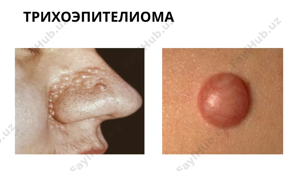 и рак) терининг хавфли усмалари орасида кенг таркалган булиб, эркак ва аёлларда, купинча катта ёшдагиларда учрайди. патологик жараён асосан юзда (куз олди соҳалари, бурун-лаб бурмаси), бошнинг чакка кисми, кулок олди ва буйинда жойлашади. базалиома узгармаган ёки патологик жараён туфайли узгарган терида (рентген дер­матити, сил, чандикди атрофияларда, гистиоцитома урнида) ва кизил югурукдан сунг пайдо булган чандикли атрофияларда ривожланиши мумкин. клиник кечиши буйича базалиоманинг юзаки усмали ярали пигментли склеродермасимон хиллари тафовут этилади. базалиома базалиома пигментли пигментли юзаки базалиомада аввалига чегараланган, кипикланувчи пушти ранг доғлар пайдо булади. кейинчалик периферияда майда тугунча кузатилади, улар қаттиқ, кизгиш-пушти ёки тери рангида булиб, бемор оғрик ва кичишиш аломатларини сезмайди. тугунча секин-аста катталашади, марказий кисмида кизил рангли пуст пайдо булади, агар у олиб ташланса, яра, унинг четида берк болишча куринади. юзаки ба­залиомада ўчокдар бир ёки бир нечта булиши мумкин. куп учокли базалиома асосан узок муддат инсоляция таъсирида булган ёки себореяли кератоз, боуэн касаллиги ва сепкили бор кишларда учрайди. …