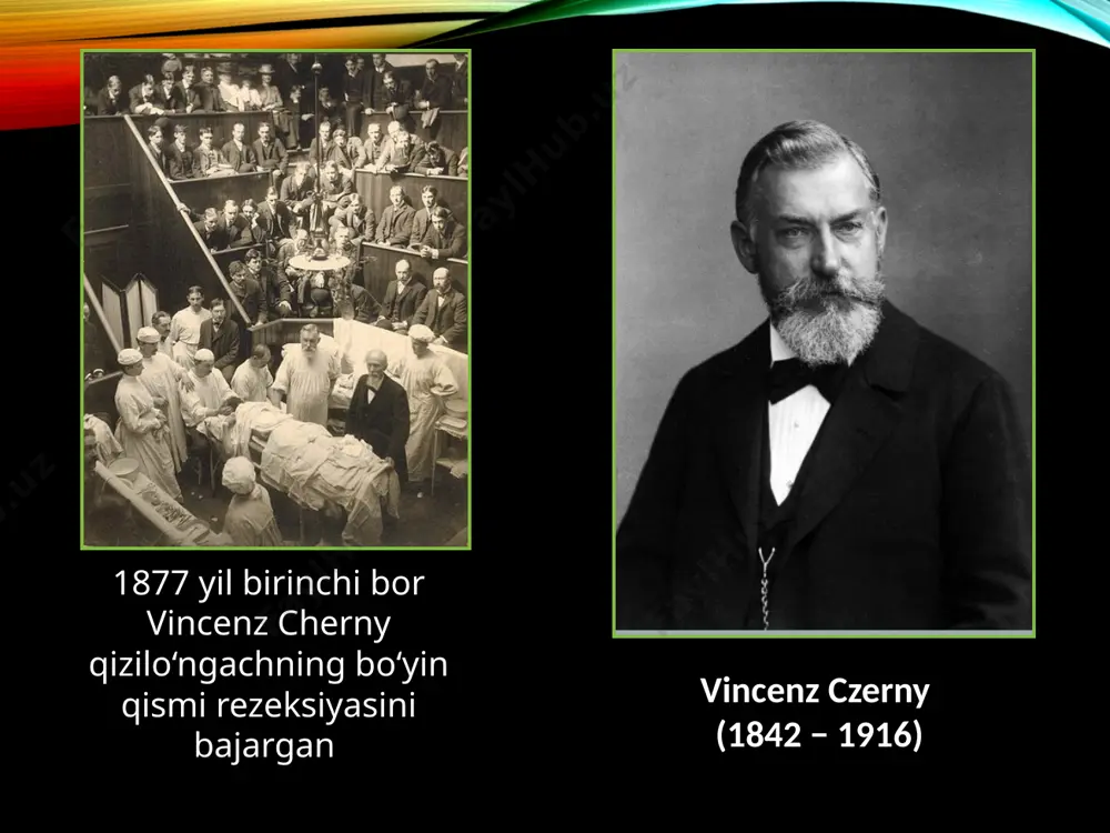 pigastral sohada og‘riq. gipersalivatsiya. disfagiya. travmadan so‘ngi birinchi soatlarda shok holati. bir necha soatdan so‘ng kuyish natijasida toksemiya belgilari kuchayib boradi sohta yaxshi bo‘lish davri (7-30 sut) tahminan 1-chi haftaning ohirida nekrozga uchragan qizilo‘ngach to‘qimasi ko‘chishi kuzatiladi, natijada qizilo‘ngach o‘tkazuvchanligi biroz tiklanadi. asorati: qizilo‘ngachdan qon ketishi, qizilo‘ngach devori perforatsiyasi, katta maydondagi jarohatlarda sepsis rivojlanishi strikturalar hosil bo‘lish davri (2 dan 6 oygacha, ba'zida yillab davom etadi) qizilo‘ngach devorida har xil maydonli, sekin bituvchi yaralar paydo bo‘ladi. yaralar fibrin bilan qoplangan, kontakt qilganda yengil qon oqishi kuzatiladi. qizilo‘ngach o‘tkazuvchanligi to‘liq yo‘qolishi bilan kechishi mumkin. strikturalarni yuqorida joylashishida qo‘yidagilar kuzatiladi: laringospazm, yo‘tal, bo‘g‘ilish belgilari ovqat luqmasini nafas yo‘liga tushishi natijasida kuzatiladi qizilo‘ngachning kuyishi va chandiqli torayishi qizilo‘ngachning yuqori qismi segmentar strikturasi qizilo‘ngachning o‘rta uchligi segmentar strikturasi qizilo‘ngachning o‘rta va pastki uchligi davomli strikturasi qizilo‘ngachning kuyishi va chandiqli torayishi qizilo‘ngach ximik kuyishlarining asoratlari erta shok halqum shishishi gemoliz kechki striktura holsizlanish o‘pka tomonidan …