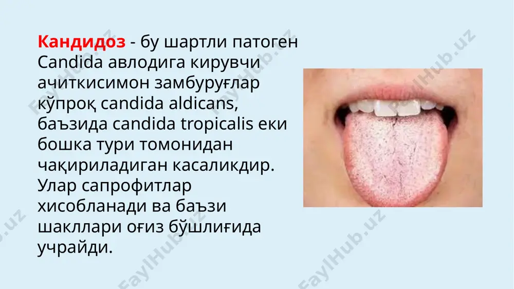 ъзида караш хар хил сохада хар хил тўпланган сузмасимон хосилани эслатади. бу айниқса ретенцион зоналарда яхши билинади. манзара замбуруғни доимий вегитацияси ва овқатланиш пайтида карашни механик тозаланиши натижасида ўзгариб туради. караш осон кўчади ва кейин гиперемия (эритема) аниқланади. оғир холларда зич караш хосил бўлиб, кийинчилик билан кўчади ва ундан сўнг қонаган эрозив юза хосил бўлади. оқ караш кўчган эпителий хужайралари, кератин, фибрин, овқат қолдиқлари, бактериялар, мицелия ипларидан иборат. шиллиқ қаватни хамма сохалари зарарланади, лекин қўпроқ лунж, танглай, тил ва лаб. жараен хиқилдоқ, халқум, қизил ўнгачга тарқалиши мумкин. бундай клиник манзара молочница сабабли candida albicans бўлганда кузатилади. агар замбуруғ флорасининг ичида candida tropicalis устунлик қилса, шиллиқ қаватда пленкали караш аниқланади. агар ўткир псевдомембраноз кандидозни даволамаса, ўткир атрофикка ўтиб, унда кучли оғриқ, оғиз бўшлиғида ачишиш ва қуриш келиб чиқади. шиллиқ қават гиперемияланган, ўткир қизил рангда, қурук бўлади. солиштирма ташхис. ўткир псевдомембраноз глоссит дескваматив глоссит билан қиесланади; ўткир кандидоз стоматитни лейкоплакия, қизил ясси …