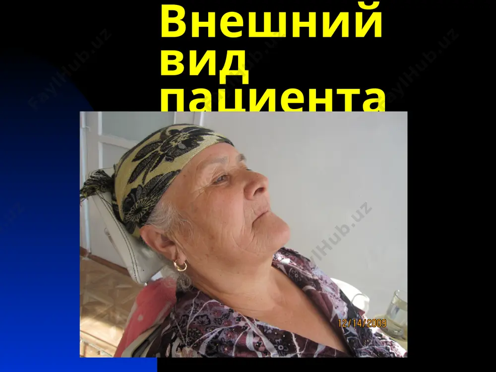и с твердым небом. при протезировании этого типа беззубой челюсти создают­ся трудности, поскольку протез приобретает значительную свободу для передних и боковых сдвигов при разжевывании пищи, а низкое прикрепление уздечек и переходной склад­ки способствует сбрасыванию протеза классификация беззубых челюстей по и.м. оксману и.м. оксман предложил единую классификацию для верхней и нижней беззубых челюстей при пер­вом типе наблюдаются незначительно и равномерно атро­фированные альвеолярные отростки, хорошо выраженные бугры верхней челюсти и свод неба, расположенные у осно­вания альвеолярного ската переходная складка и точки при­крепления уздечек и щечных тяжей. для второго типа ха­рактерны средневыраженная атрофия альвеолярного отро­стка и бугров верхней челюсти, менее глубокое небо и более низкое прикрепление подвижной слизистой оболочки. при третьем типе наблюдается резкая, но равномерная атрофия альвеолярного отростка и верхнечелюстных бугров, уплощение небного свода. подвижная слизистая оболочка прикреплена на уровне вершины альвеолярного отростка. четвертый тип характеризуется неравномерной атрофи­ей альвеолярного отростка. классификация беззубых челюстей по и.м. оксману первый тип беззубой нижней челюсти характеризуется …