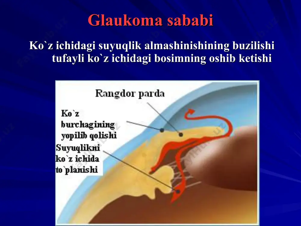 jismoniy charchash, kasalliklar va shu kabilardan keyin boshlanishi mumkin belgilari: ko`zda va boshining tegishli tomonida azob beruvchi og`riq paydo bo`lishi, bu og`riqni tishga ham o`tishi ko`pincha qusish, ba’zan isitma ham chiqishi qovoqlar anchagina shishishi ko`zdan yosh oqishi ko`z shilliq pardasini qizarib ketishi shox pardani xiralashuvi va shishi, g`adir-budur bo`lib qolib, uning sezgirligini keskin kamayishi yoki mutlaqo yo`qolishi old kamerani juda yuza bo`lib qolishi yoki butunlay yo`qolishi qorachiqni sarg`imtir-yashil rangga ega, kengaygan, yorug`likka kam reaktsiya qiladi yoki mutlaqo o`zgarmaydi shox parda va shishasimon tana juda shishganligi sababli ko`z tubi oftalmoskopda ko`rinmaydi ko`z ichidagi bosim juda oshgan – «ko`z toshdek qattiq» ko`rish anchagina, ba’zan yorug`likni sezishgacha pasaygan. bayon qilingan alomatlar glaukomaning o`tkir xuruji uchun juda xarakterli, biroq sinchiklab qaralmasa, diagnostik xatoga yo`l qo`yilib, bemor ko`zi hatto ko`r bo`lib qolishi mumkin. glaukomaning o`tkir xurujida shoshilinch yordam ko`rsatish har 15-30 minutda ko`zga pilokarpin tomiziladi, xuruj alomatlari kamaygani sari uni har 1-2 soatda va bundan …