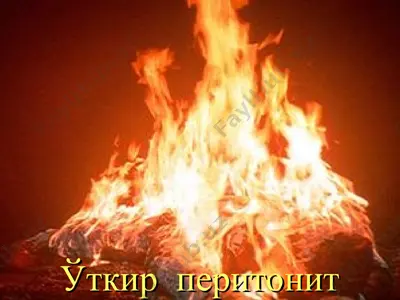 ўткир перитонит — PPT