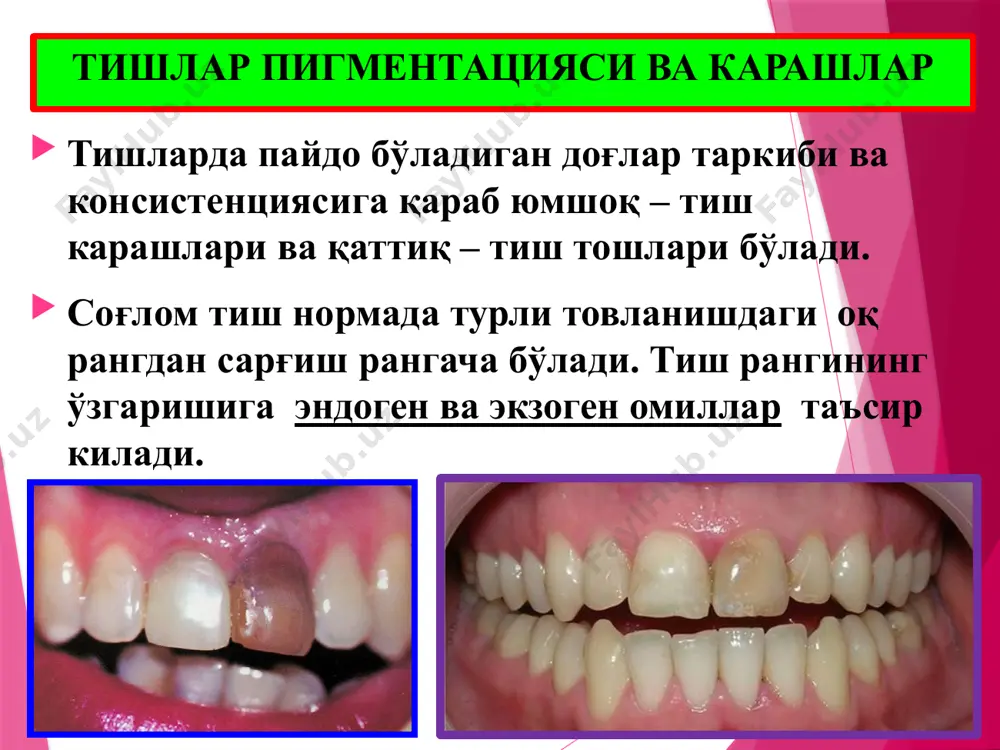 узилиши экзоген омиллар касбий зарарли омиллар: қаттиқ овқат: прикус нуқсони: тиш пасталар, асосан тиш кукунлар: бруксизм: норационал протезлаш: ионизирловчи радиация: тишларни қисман йўқотилиши, асосан молярларни: тишларни патологик едирилишининг локализация ва даражасига асосланган клиник-анатомик таснифи: i даража – тиш тож қисмини кесув қирра ва дўмбоқларидаги эмални қисман емирилиши; ii даража – қозиқ, премоляр ва моляр тишлар дўмбоқларининг эмаль қаватини ва курак тишларни кесув қиррасини дентинининг юза қаватларигача емирилиши; iii даража – эмал ва дентинни тиш бўшлиғининг тож сохасигача тўлиқ емирилиши. патологик анатомияси: бошланғич даврларда емирилиш сохасида жадал равишдаги иккиламчи дентинни йиғилиши аниқланади. емирилишнинг ўрта оғирлик даражасида дентин каналчаларнинг обтурацияси кўринади. пульпадаги ўзгаришлар: одонтобластлар сонининг камайиши, уларнинг вакуолизацияси ва атрофияси. емирилишнинг 3-4-даражасида тиш бўшлиғи иккиламчи дентин билан тўлган, пульпа атрофияси ва илдиз каналининг облитерацияси аниқланади. локал тишларнинг патологик емирилиш шаклларининг клиник белгилари горизонтал шакли эмал ва дентинда горизонтал шаклдаги нуқсон тиш чиққандан сўнг юзага келади вертикал шакли эмал ва дентинда секин вертикал …