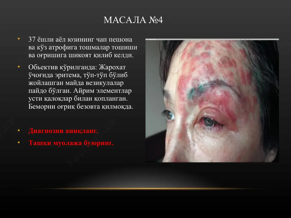 №16 2 oylik chaqaloqda tabiiy burmalar sohasida ko'plab vezikulyoz va pustulyoz toshmalar kuzatiladi, katta eroziya sathlari va atrofiyada papulyoz elementlari bor. og'iz atrofida ham yuqoridagi kabi toshmalar mavjud. bemorda tez-tez ich ketishi, sochlar to'kilishi, tirnoqning distrofik o'zgarishi paronixiya va onixiya kuzatilmoqda. umumiy ahvoli og'ir. sizning tashxisingiz? asosiy davo choralari. masala №17 dermatolog huzuridagi 6 yoshli qizchaning yuzlari, pastki jag'i terisida ko'pgina fliktena elementlari, eroziyalar mavjud bo'lib, eroziyalar usti qaloqlar bilan qoplangan. elementlar atrofida giperemiya xoshiyasi kuzatiladi. jarayon sohasi asta-sekin kattalashib bormoqda. qaysi kasallik haqida o'ylash kerak? tashqi davolash uchun nima buyuriladi? masala №18 bemor a. xirurg huzuriga chov soxasi atrofida toshma toshishiga shikoyat qilib keldi. ob'ektiv ko'rilganda: chov soxasi atrofida yuzasi eroziyalangan, namlanuvchi, vegetatsiyalangan papulalar bor. bemor tanasida kattaligi 1 so'mlik tangadek keladigan oz miqdordagi oqish-pushti rangdagi rozeolalar bor. bemorda qanday kasallik bo'lishi mumkin? bemorni qaysi mutaxassis ko'rishi kerak? qanday laboratoriya analizlari qilish kerak? masala №19 teri bo'limiga 22 yoshli …