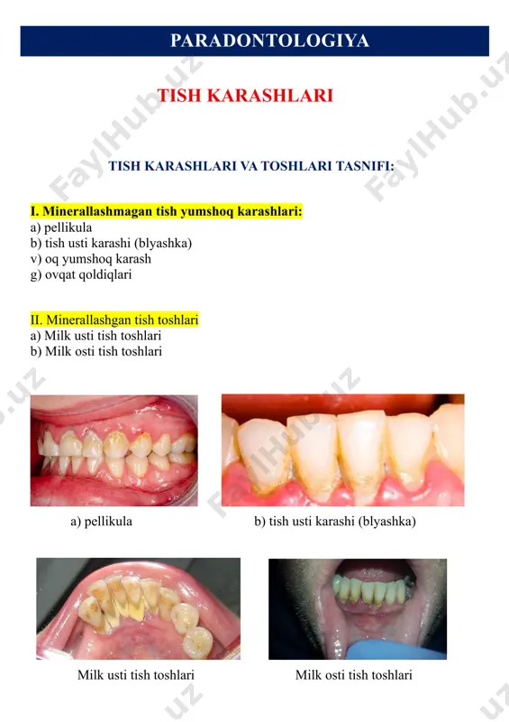 tsiy, fosfatlar, magniy, kaliy, natriy) dan hosil bo`lgan asosga kirib, koloniyalar hosil kilgan mikroorganizmlardan iboratdir. tish usti karashi-blyashka rangsiz, yumshoq cho`kma bo`lib, maxsus tarkibida yod saqlovchi eritmalar yoki fuksin, eritrozin kabi bo`yoqlar bilan yaxshi bo`yalib aniqlanadi. tish usti karashi og`izni chayish, cho`tka, pasta yordamida tozalashdan keyin ham tish bo`yin sohalarida notekis, sillik bo`lmagan yuzani hosil kilib turadi. paradontologiya aynan mana shu sohada mikroorganizmlarning faol xayot faoliyati kechadi. bu faoliyat natijasida fermentlar ishtrokidagi, faol parchalanish, bijg`ish, kislotalar hosil bo`lish jarayoni kuzatiladi. blyashka tozalanib emal yuzasi ochilganda ba’zan emal sathida xiralashgan demineralizatsiya sohalarini ko`rish mumkin. paradontologiya tish usti karashlari asosan tishning milk usti sathida, fissuralarga kirish sohasida, kontakt yuzalarda tez vujudga keladi. karashlarning 80- 85% i suv bo`lib, mineral moddalarning asosini kaltsiy, anorganik fosfatlar va ftoridlar tashkil qiladi. kaltsiy moddasi tish usti karashlarida bakteriyalar, hujayralardan tashqari oqsillar, fosfatlar bilan bog`langan xolda bo`lib, anorganik ortofosfat yoki organik birikmalar hosil bo`lishida ishtirok etadi. tish …