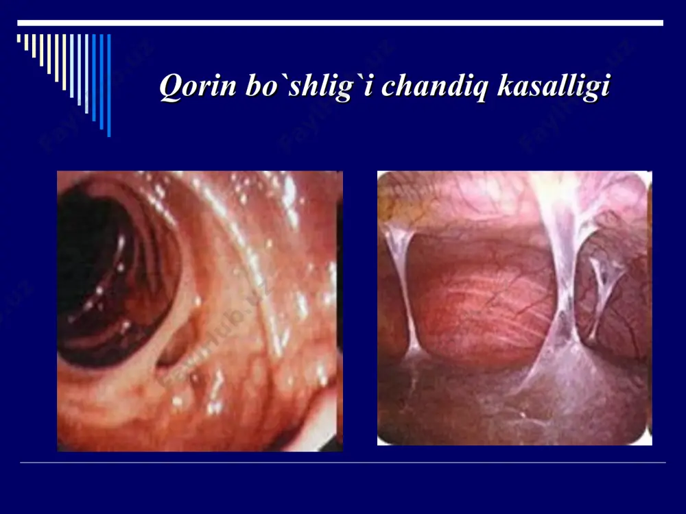 pishishlarga bo'linadi. (ichak - parietal periton). qorin bo`shlig`i chandiq kasalligi . suratda: viscero-parietal termoyadroviy, yupqa soha ichaklar parietal peritonga lehimlangan etiologiyasi peritoneal qatlamlarni yopishtirishga olib keladigan sabablar omentumning shikastlangan peritonning joylariga lehimlanishiga olib keladigan sabablar. qorin pardasiga tushib, asta-sekin biriktiruvchi to'qima kordlariga aylanadigan fibrinning yo'qolishi.. etiologiyasi bu sabablarning barchasi o'tkir ichak tutilishining rivojlanishiga sabab bo'lishi mumkin bo'lgan planar yoki strand adezyonlarining shakllanishiga olib keladi. bu sabablarning barchasi ba'zida okn klinikasi bilan yuzaga keladigan yopishqoq kasallikning rivojlanishiga sabab bo'ladi. ba'zi mualliflar yopishqoq kasallikni okn ning majburiy mavjudligi sifatida izohlaydilar, ammo bu shunday emas. adezyonlarning paydo bo'lishining asosiy sababi peritonning shikastlanishidir. qorin bo`shlig`i chandiq kasallik sabablari qorin bo`shlig`i chandiq kasalligi sabablari tos a'zolarining yallig'lanishi appenditsit qorin parda va qorin bo'shlig'i va tos a'zolarining travmatik (mexanik) shikastlanishi qorin bo'shlig'iga qon ketishi begona jismlarga ta'sir qilish va qorin bo'shlig'i va tos a'zolariga jarrohlik aralashuvi endometrioz qorin bo`shlig`i chandiq kasalligi sabablari qorin bo'shlig'idagi bitishmalar ichki …